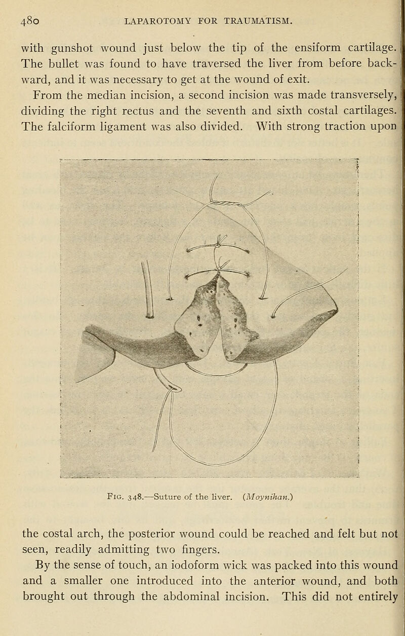 with gunshot wound just below the tip of the ensiform cartilage. The bullet was found to have traversed the liver from before back- ward, and it was necessary to get at the wound of exit. From the median incision, a second incision was made transversely, dividing the right rectus and the seventh and sixth costal cartilages. The falciform ligament was also divided. With strong traction upon i^iji^w.^!..,^... .. ..' -.._' ' Fig. 348.—Suture of the liver. (Moynihan.) the costal arch, the posterior wound could be reached and felt but not seen, readily admitting two fingers. By the sense of touch, an iodoform wick was packed into this wound and a smaller one introduced into the anterior wound, and both brought out through the abdominal incision. This did not entirely