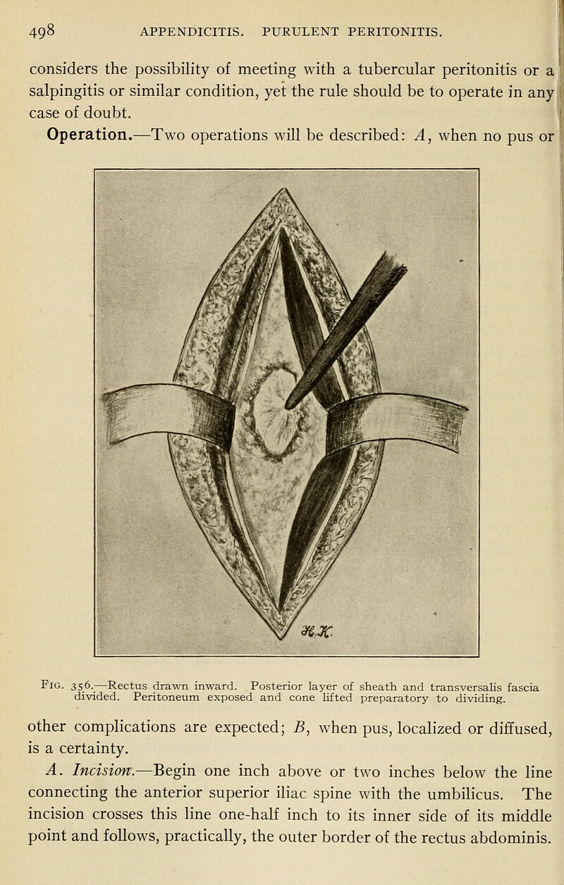 considers the possibility of meeting with a tubercular peritonitis or a salpingitis or similar condition, yet the rule should be to operate in any case of doubt. Operation.—Two operations will be described: A, when no pus or Fig. 356.—Rectus drawn inward. Posterior layer of sheath and transversalis fascia divided. Peritoneum exposed and cone lifted preparatory to dividing. other complications are expected; B, when pus, localized or diffused, is a certainty. A. Incision.—Begin one inch above or two inches below the line connecting the anterior superior iliac spine with the umbilicus. The incision crosses this line one-half inch to its inner side of its middle point and follows, practically, the outer border of the rectus abdominis.