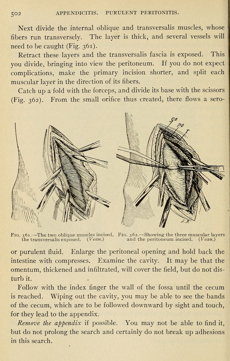 5°2 Next divide the internal oblique and transversalis muscles, whose fibers run transversely. The layer is thick, and several vessels will need to be caught (Fig. 361). Retract these layers and the transversalis fascia is exposed. This you divide, bringing into view the peritoneum. If you do not expect complications, make the primary incision shorter, and split each muscular layer in the direction of its fibers. Catch up a fold with the forceps, and divide its base with the scissors (Fig. 362). From the small orifice thus created, there flows a sero- Fig. 361.—The two oblique muscles incised, Fig. 362.—^Showing the three muscular layers the transversalis exposed. (Veau.) and the peritoneum incised. (Veau.) or purulent fluid. Enlarge the peritoneal opening and hold back the intestine with compresses. Examine the cavity. It may be that the omentum, thickened and infiltrated, will cover the field, but do not dis- turb it. Follow with the index finger the wall of the fossa until the cecum is reached. Wiping out the cavity, you may be able to see the bands of the cecum, which are to be followed downward by sight and touch, for they lead to the appendix. Remove the appendix if possible. You may not be able to find it, but do not prolong the search and certainly do not break up adhesions in this search.