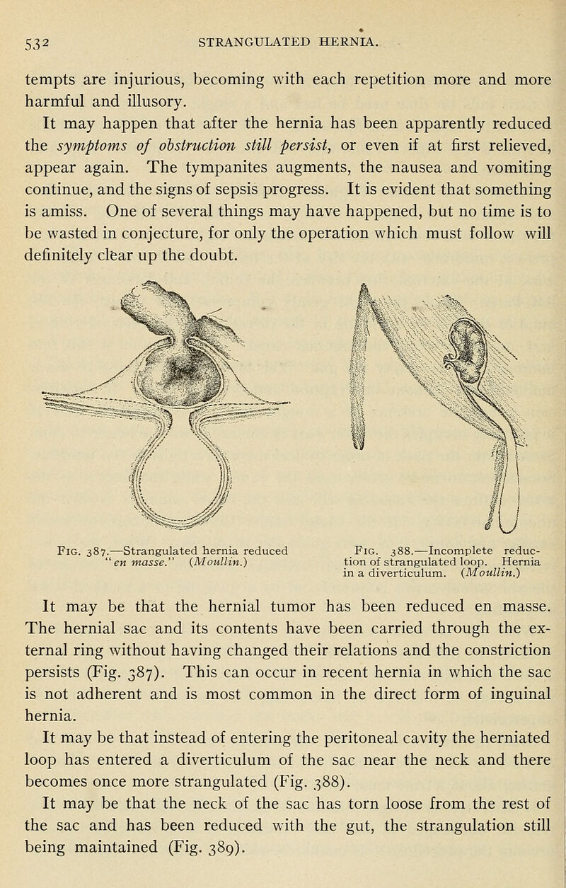 tempts are injurious, becoming with each repetition more and more harmful and illusory. It may happen that after the hernia has been apparently reduced the symptoms of obstruction still persist, or even if at first relieved, appear again. The tympanites augments, the nausea and vomiting continue, and the signs of sepsis progress. It is evident that something is amiss. One of several things may have happened, but no time is to be wasted in conjecture, for only the operation which must follow will definitely clear up the doubt. Fig. 387.—Strangulated hernia reduced  en masse. (Moullin.) Fig. 388.—Incomplete reduc- tion of strangulated loop. Hernia in a diverticulum. (Moullin.) It may be that the hernial tumor has been reduced en masse. The hernial sac and its contents have been carried through the ex- ternal ring without having changed their relations and the constriction persists (Fig. 387). This can occur in recent hernia in which the sac is not adherent and is most common in the direct form of inguinal hernia. It may be that instead of entering the peritoneal cavity the herniated loop has entered a diverticulum of the sac near the neck and there becomes once more strangulated (Fig. 388). It may be that the neck of the sac has torn loose from the rest of the sac and has been reduced with the gut, the strangulation still being maintained (Fig. 389).