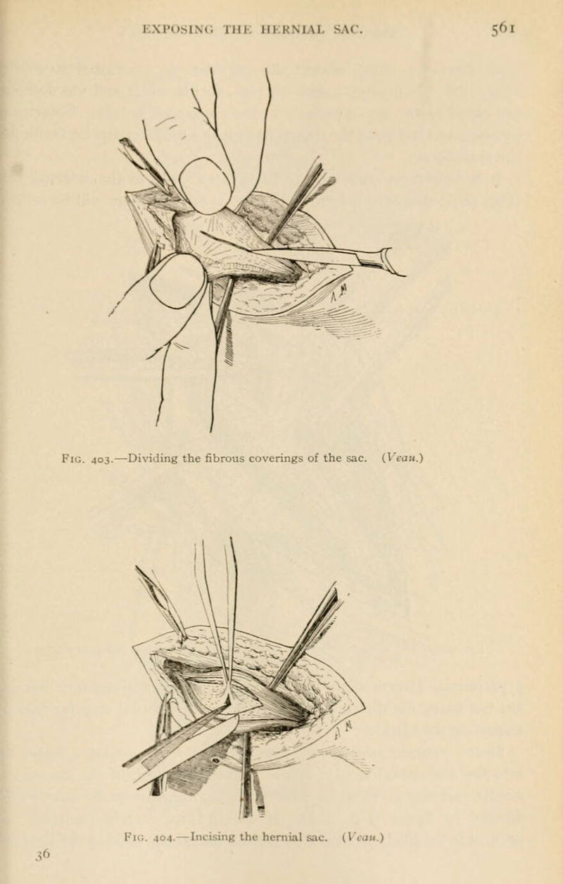 Fig. 403.—Dividing the fibrous coverings of the sac. (I eau.) Pio. 404. Incising tlu- hernial sac. il tan 1 36