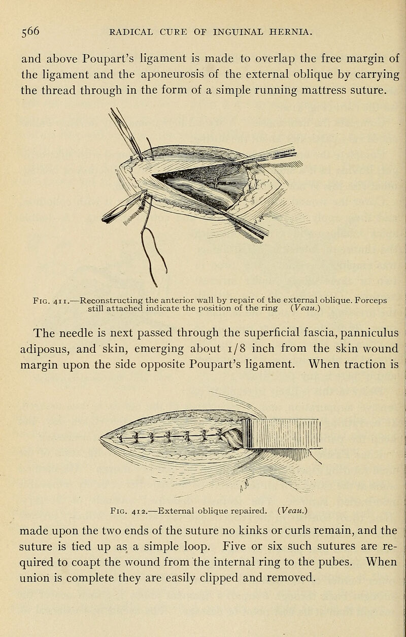 and above Poupart's ligament is made to overlap the free margin of the ligament and the aponeurosis of the external oblique by carrying the thread through in the form of a simple running mattress suture. Fig. 411. -Reconstructing the anterior wall by repair of the external oblique. Forceps still attached indicate the position of the ring (Veau.) The needle is next passed through the superficial fascia, panniculus adiposus, and skin, emerging about 1/8 inch from the skin wound margin upon the side opposite Poupart's ligament. When traction is Fig. 412.—External oblique repaired. (Veau.) made upon the two ends of the suture no kinks or curls remain, and the suture is tied up as a simple loop. Five or six such sutures are re- quired to coapt the wound from the internal ring to the pubes. When union is complete they are easily clipped and removed.