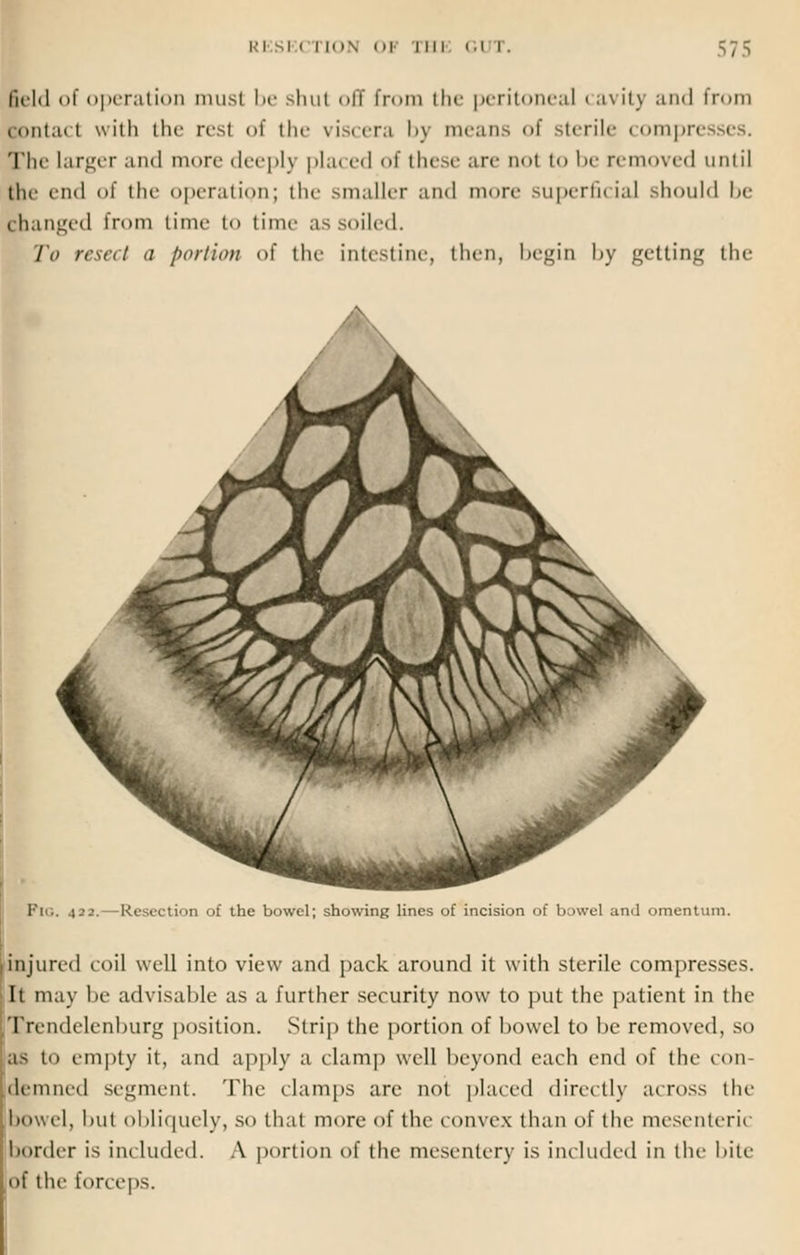 field of operation must be shut <>iT from the peritoneal cavity :imI from jontact with the resl of the viscera by means of sterile compr< The larger and more deeply placed of these are iml to be removed Until the i-ii<l of the operation; the smaller and mure superficial should be Banged from time to time as soiled. To resect a portion of the intestine, then, begin by getting the Fii.. 422.—Resection of the bowel; showing lines of incision of bowel and omentum. injured coil well into view and pack around it with sterile compresses. It may be advisable as a further security now to put the patient in the Trendelenburg position. Strip the portion of bowel to be removed, so ;as to empty it, and apply a clamp well beyond each end of the con- demned segment. The clamps are not placed directly across the ■bowel, but obliquely, so that more of the convex than of the mesenterit border is included. A portion of the mesentery is included in the bite of the forceps.