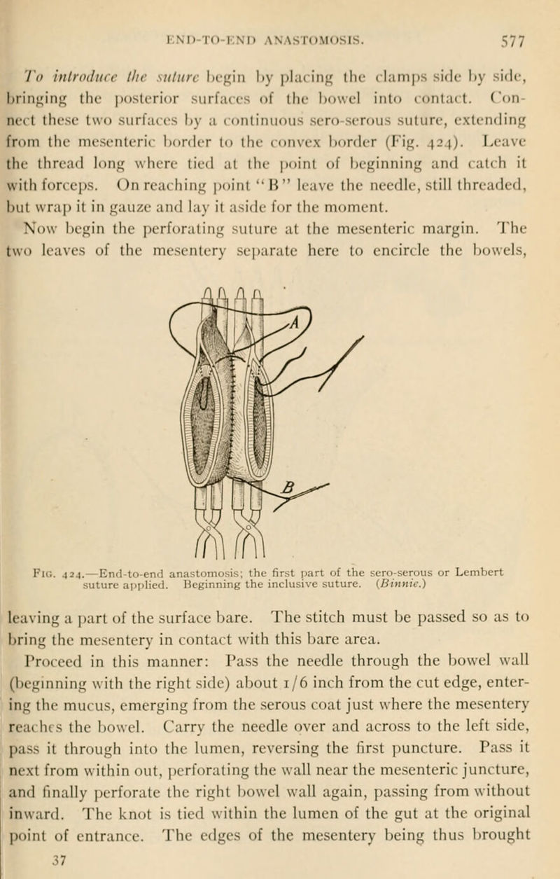 To in i rod me the suture begin by placing the clamps side by side, bringing the posterior surfaces of the bowel into contact. Con led these two surfaces by .1 continuous sero serous suture, extending worn the mesenteric border to the convex border (Fig. \?\). Leave the thread long where tied at the point of beginning and catch it with forceps. < >n rea< hing poinl  B  leave the needle, still threaded, hut wrap it in gauze and Lay it aside for the moment. Now begin the perforating suture at the mesenteric margin. The two leaves of the mesentery separate here to encircle the dowels, PlG. 434.—End-to-end anastomosis; the first part of the sero-serous or Lembert suture applied. Beginning the inclusive suture. (Binnie.) leaving a part of the surface bare. The stitch must be passed so as to bring the mesentery in contact with this bare area. Proceed in this manner: Pass the needle through the bowel wall [beginning with the right side) about 1/6 inch from the cut edge, enter ing the mucus, emerging from the serous coat just where the mesentery rcu< In s the bowel. Carry the needle over and across to the left side, pass it through into the lumen, reversing the first puncture. Pass it next from within out. perforating the wall near the mesenteric juncture, and finally perforate the right bowel wall again, passing from without inward. The knot is tied within the lumen of the gut at the original point of entrance. The edges of the mesentery being thus brought 37