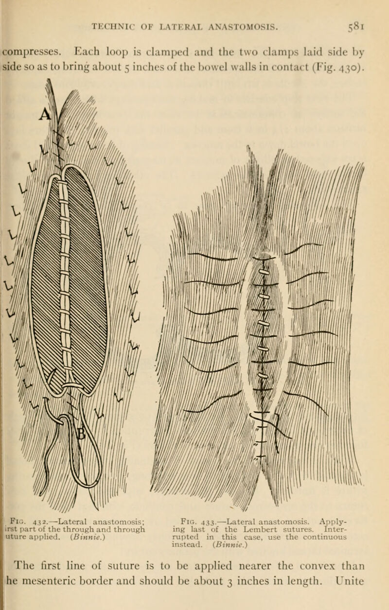 compresses. F.ach loop is clamped and the two clamps laid side by side so as to bring about 5 inches of the bowel walls in contact I Fig. 430). Pi is-. -Lateral anastomosis; irst part of the through and through uture applied. (Binnie.) Fin. 433.—Lateral anastomosis. in^' last of the Lembert sutures. Inter- rupted in this ease, use the continuous instead. (Binnie.) The first line of suture is to be applied nearer the convex than he mesenteric border and should be about 3 inches in length. Unite