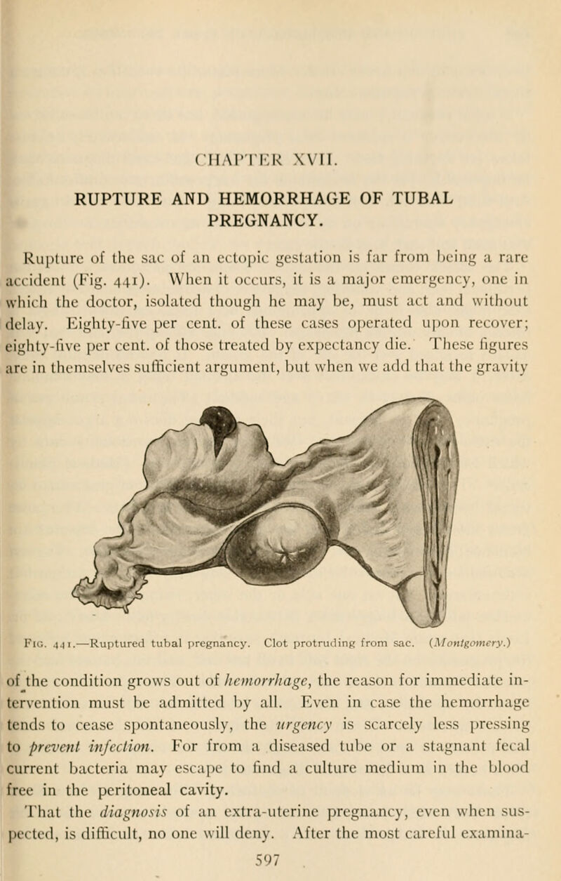 CHAPTER XVII. RUPTURE AND HEMORRHAGE OF TUBAL PREGNANCY. Rupture of the sac of an ectopic gestation is far Erom being a rare accident (Fig. 441). When it occurs, it is a major emergency, one in which the doctor, isolated though he may be, must act and without Belay. Eighty-five per cent, of these cases operated upon recover; Eighty-five per cent, of those treated by expectancy die. These figures are in themselves sufficient argument, but when we add that the gravity Pig. 441.—Ruptured tubal pregnancy. Clot protruding from sac. (Montgomei of the condition grows out of hemorrhage, the reason for immediate in- tervention must be admitted by all. Even In case the hemorrhage tends to cease spontaneously, the urgency is scarcely less pressing to prevent in fee lion. For from a diseased tube or a Stagnant fecal current bacteria may escape to find a culture medium in the blood fnr in the peritoneal cavity. That tin- diagnosis of an extra-uterine pregnancy, even when sus- pected, is difficult, no one will deny. After the most careful examina