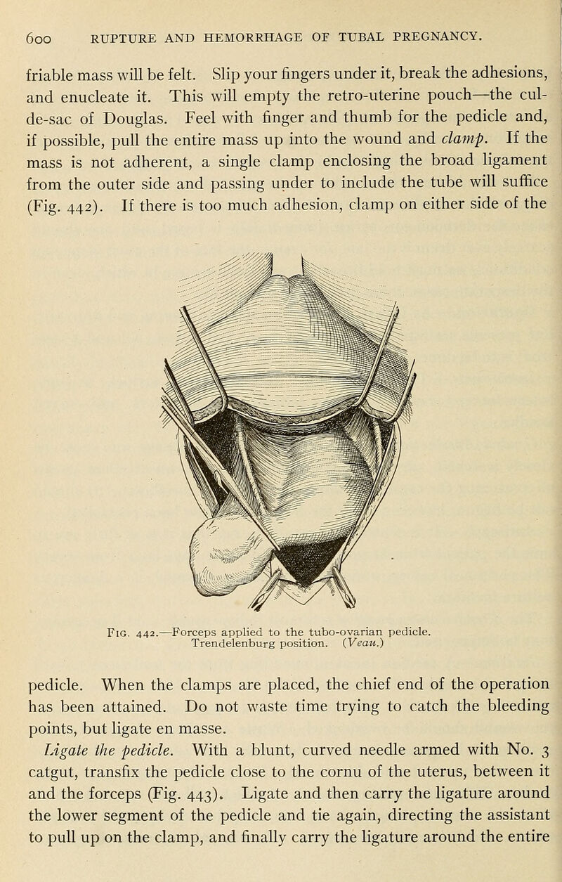 friable mass will be felt. Slip your fingers under it, break the adhesions, and enucleate it. This will empty the retro-uterine pouch—the cul- de-sac of Douglas. Feel with finger and thumb for the pedicle and, if possible, pull the entire mass up into the wound and clamp. If the mass is not adherent, a single clamp enclosing the broad ligament from the outer side and passing under to include the tube will suffice (Fig. 442). If there is too much adhesion, clamp on either side of the Fig. 442-- -Forceps applied to the tubo-ovarian pedicle. Trendelenburg position. (Veau.) pedicle. When the clamps are placed, the chief end of the operation has been attained. Do not waste time trying to catch the bleeding points, but ligate en masse. Ligate the pedicle. With a blunt, curved needle armed with No. 3 catgut, transfix the pedicle close to the cornu of the uterus, between it and the forceps (Fig. 443). Ligate and then carry the ligature around the lower segment of the pedicle and tie again, directing the assistant to pull up on the clamp, and finally carry the ligature around the entire