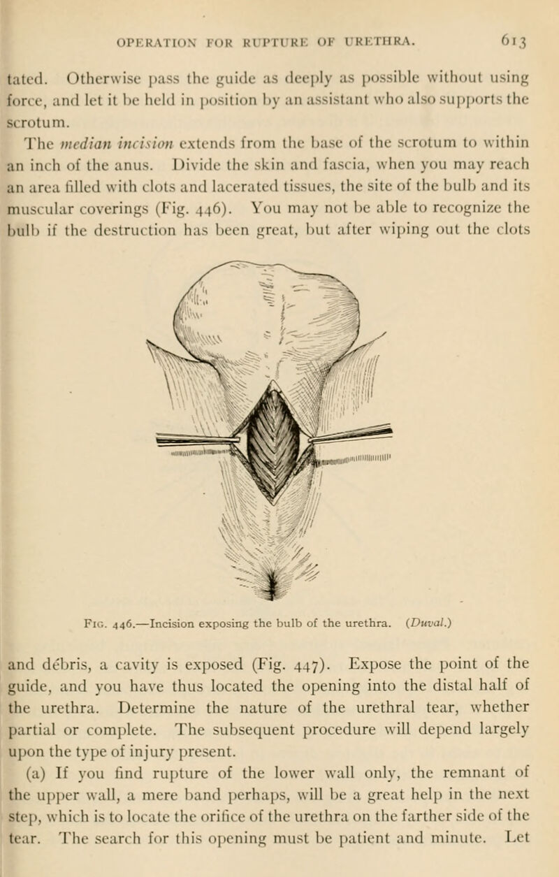 jated. Otherwise pass the guide as deepl) as possible without usin^ i'<.r. e, and let it be held in position by an assistant who also supports the si rotum. The median incision extends from the base of the s< rotum to within an inch of the anus. Divide the skin and fascia, when you may rra. h an area filled with clots and Lacerated tissues, the site of the bulb and its muscular coverings (Fig. 446). You may not be able to recognize the hull) it' the destruction has been great, but after wiping out the clots Pic. 446.—Incision exposing the bulb of the urethra. (Duval.) and debris, a cavity is exposed (Fig. 447). Expose the point of the guide, and you have thus located the opening into the distal half of the urethra. Determine the nature of the urethral tear, whether partial or complete. The subsequent procedure will depend largely upon the type of injury present. (a) If you find rupture of the lower wall only, the remnant of the upper wall, a mere band perhaps, will be a great help in the next step, which is to locate tin- orifice of the urethra on the farther side of the fear. The search lor this opening must be patient and minute. Let