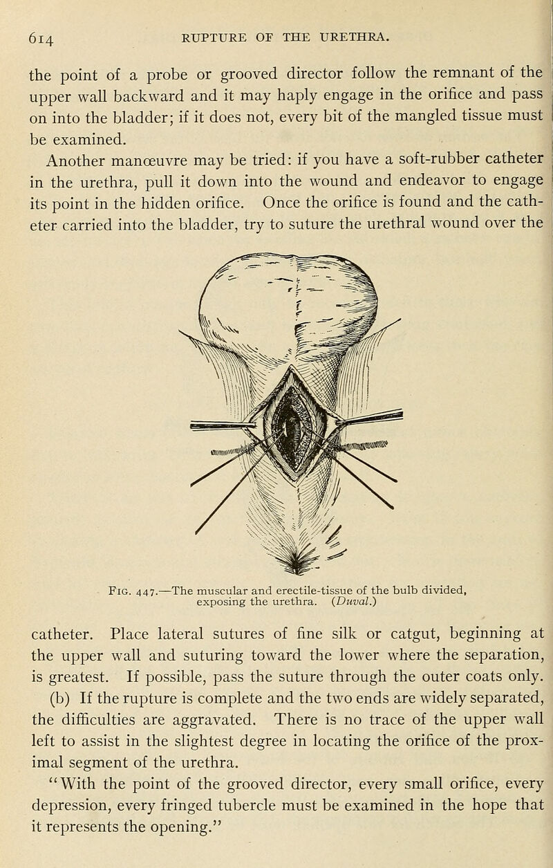 the point of a probe or grooved director follow the remnant of the upper wall backward and it may haply engage in the orifice and pass on into the bladder; if it does not, every bit of the mangled tissue must be examined. Another manoeuvre may be tried: if you have a soft-rubber catheter in the urethra, pull it down into the wound and endeavor to engage its point in the hidden orifice. Once the orifice is found and the cath- eter carried into the bladder, try to suture the urethral wound over the Fig. 447.—The muscular and erectile-tissue of the bulb divided, exposing the urethra. (Duval.) catheter. Place lateral sutures of fine silk or catgut, beginning at the upper wall and suturing toward the lower where the separation, is greatest. If possible, pass the suture through the outer coats only. (b) If the rupture is complete and the two ends are widely separated, the difficulties are aggravated. There is no trace of the upper wall left to assist in the slightest degree in locating the orifice of the prox- imal segment of the urethra. With the point of the grooved director, every small orifice, every depression, every fringed tubercle must be examined in the hope that it represents the opening.