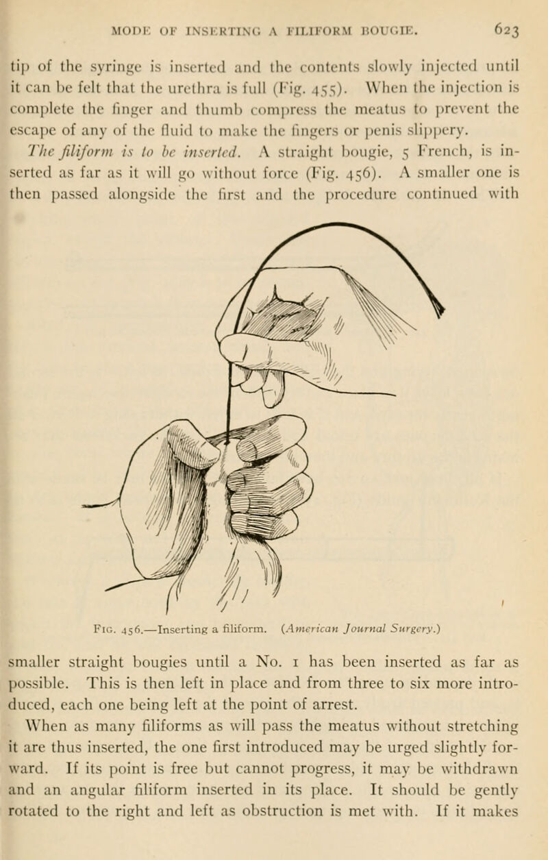 tip of the syringe is inserted and the contents slowly injected until it can be fell thai the urethra is full (Fig. 455). When the injection is complete the finger and thumb compress the meatus to prevent the escape of any of the fluid to make the fingers or penis slippery. The filiform is to be inserted. A straight bougie, 5 French, is in- serted as far as it will go without force (Fig. 456). A smaller one is then passed alongside the firsl and the procedure continued with Pig. jsfj.—Inserting a filiform. {American Journal Surgery.) smaller straight bougies until a No. 1 has been inserted as far as possible. This is then left in place and from three to six more intro- duced, each one being left at the point of arrest. When as many fdiforms as will pass the meatus without stretching it are thus inserted, the one first introduced may be urged slightly for- ward. If its point is free but cannot progress, it may be withdrawn and an angular filiform inserted in its place. It should be gently rotated to the right and left as obstruction is met with. If it makes