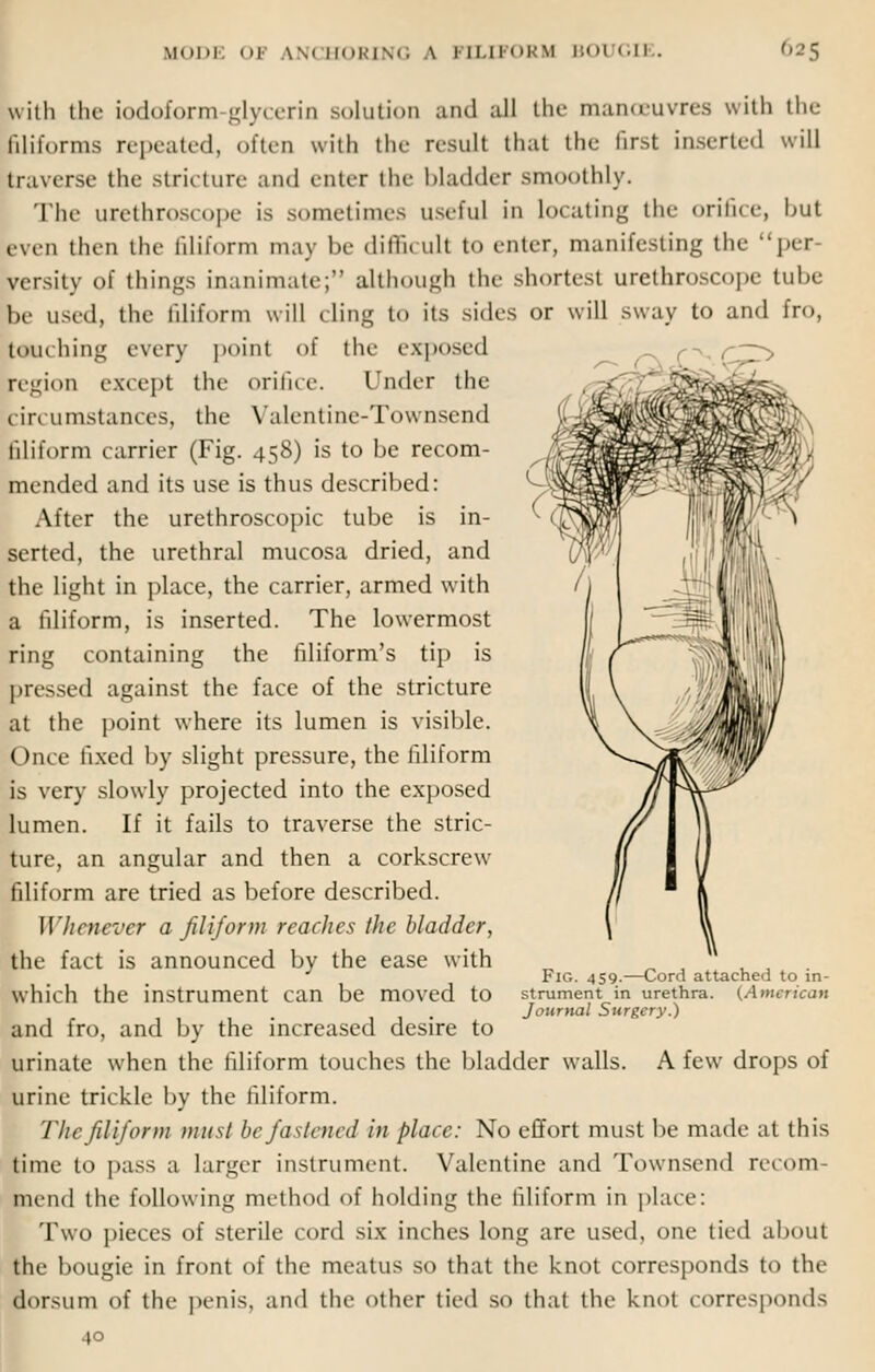 MODI I \\< BORING \ I [LIFORM BOl GIE. with the iodoform glycerin solution and all the manoeuvres with the liliiorms repeated, often with the result that the first inserted will traverse the stricture and enter the bladder smoothly. The urethroscope is sometimes useful in locating the orifice, but even then the aliform may be difficult to enter, manifesting the per vcrsity of things inanimate; although the shortest urethroscope tube be used, the filiform will cling to its sides or will sway to and fro, touching every point of the exposed region except the orifice. Under the tin umstances, the Valentine-Townsend filiform carrier (Fig. 458) is to be recom- mended and its use is thus described: After the urethroscopic tube is in- serted, the urethral mucosa dried, and the light in place, the carrier, armed with a filiform, is inserted. The lowermost ring containing the filiform's tip is pressed against the face of the stricture at the point where its lumen is visible. Once fixed by slight pressure, the filiform is very slowly projected into the exposed lumen. If it fails to traverse the stric- ture, an angular and then a corkscrew filiform are tried as before described. Whenever a filiform reaches the bladder, the fact is announced by the ease with which the instrument can be moved to and fro, and by the increased desire to urinate when the filiform touches the bladder walls, urine trickle by the filiform. The filiform must be fastened in place: No effort must be made at this time to pass a larger instrument. Valentine and Townsend recom- mend the following method of holding the filiform in place: Two pieces of sterile cord six inches long are used, one tied about the bougie in front of the meatus so that the knot corresponds to the dorsum of the penis, and the other tied so thai the knot corresponds 40 Fig. 459.—Cord attached to in- strument in urethra. {American Journal Surgery.) A few drops of