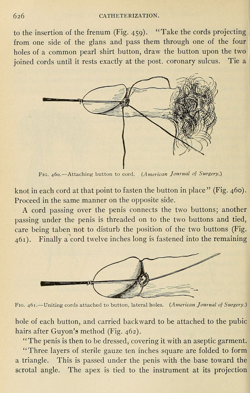 to the insertion of the frenum (Fig. 459). Take the cords projecting from one side of the glans and pass them through one of the four holes of a common pearl shirt button, draw the button upon the two joined cords until it rests exactly at the post, coronary sulcus. Tie a Fig. 460.—Attaching button to cord. (American Journal of Surgery.) knot in each cord at that point to fasten the button in place (Fig. 460). Proceed in the same manner on the opposite side. A cord passing over the penis connects the two buttons; another passing under the penis is threaded on to the two buttons and tied, care being taben not to disturb the position of the two buttons (Fig. 461). Finally a cord twelve inches long is fastened into the remaining Fig. 461.—Uniting cords attached to button, lateral holes. (American Journal of Surgery.) hole of each button, and carried backward to be attached to the pubic hairs after Guyon's method (Fig. 462). The penis is then to be dressed, covering it with an aseptic garment. Three layers of sterile gauze ten inches square are folded to form a triangle. This is passed under the penis with the base toward the scrotal angle. The apex is tied to the instrument at its projection