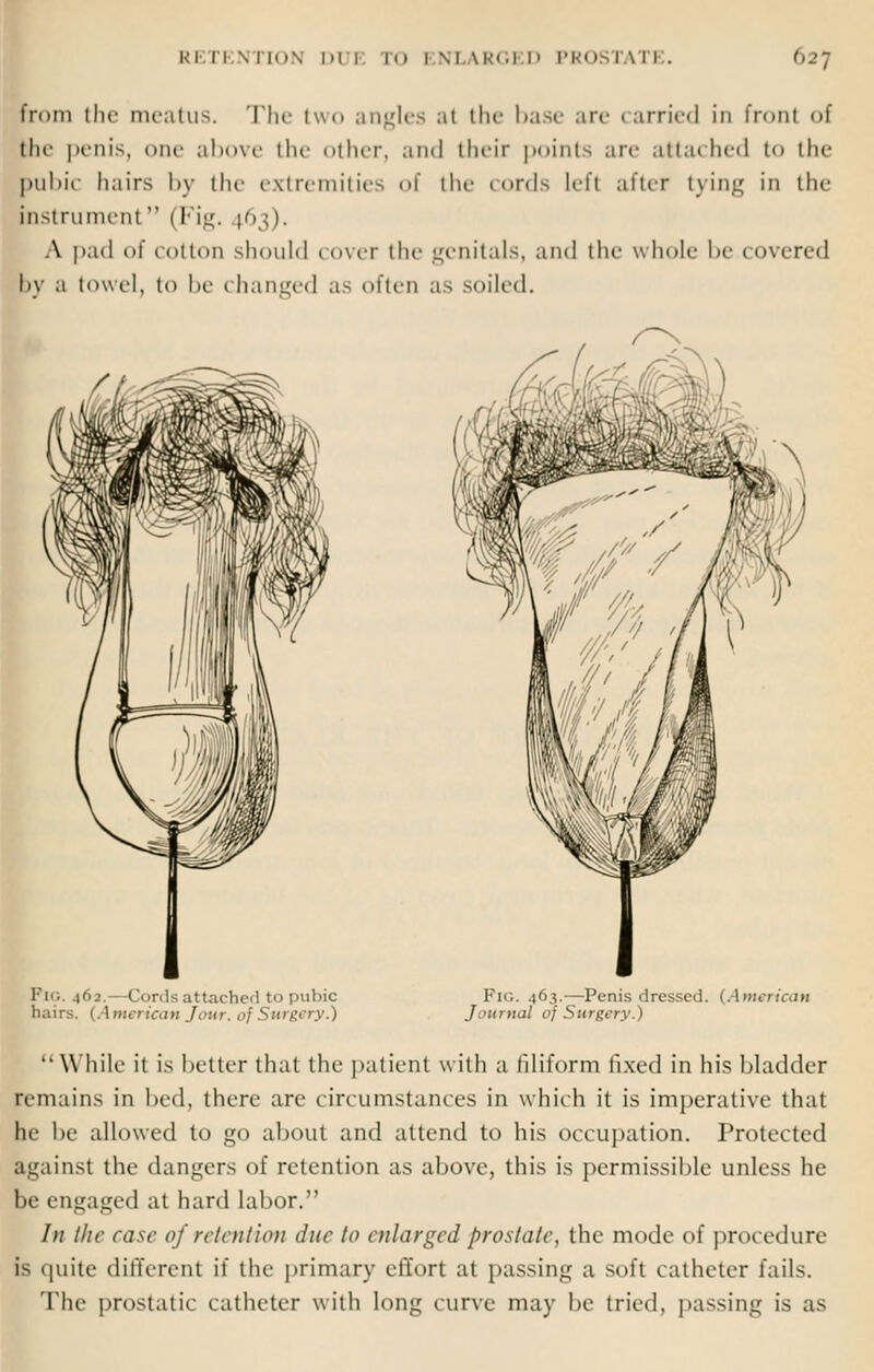 prom tin- meatus. The two angles at the base are carried in front of tIn- penis, one above the other, and their points arc attached to the pubic hairs by the extremities of the cords left after lying in the instrument (Fig. 1.63). A pad of cotton should cover the genitals, and the whole be covered by a towel, to be changed as often as soiled. Pig. \<<2. Cords attached to pubic hairs. (American Jour, of Surgery.) Fig. 463.—Penis dressed. (American Journal of Surgery. I  While it is better that the patient with a filiform fixed in his bladder remains in bed, there are circumstances in which it is imperative that he be allowed to go about and attend to his occupation. Protected against the dangers of retention as above, this is permissible unless he be engaged at hard labor. /;/ the rase of retention due to enlarged prostate, the mode of procedure is quite different if the primary effort at passing a soft catheter tails. The prostatic catheter with long curve may be tried, passing is as