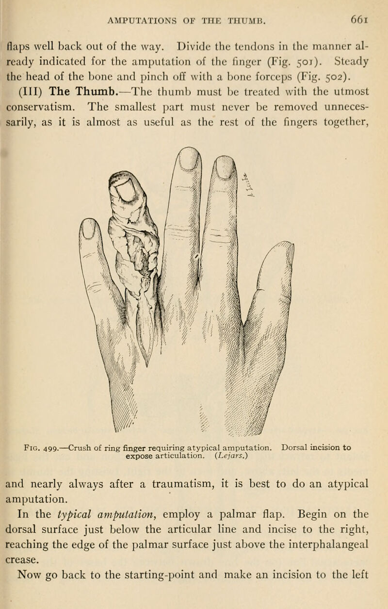 flaps well back out of the way. Divide the tendons in the manner al- ready indicated for the amputation of the finger (Fig. 501). Steady the head of the bone and pinch off with a bone forceps (Fig. 502). (Ill) The Thumb.—The thumb must be treated with the utmost conservatism. The smallest part must never be removed unneces- sarily, as it is almost as useful as the rest of the fingers together, Fig. 499.—Crush of ring finger requiring atypical amputation. Dorsal incision to expose articulation. (Lejars.) and nearly always after a traumatism, it is best to do an atypical amputation. In the typical amputation, employ a palmar flap. Begin on the dorsal surface just below the articular line and incise to the right, reaching the edge of the palmar surface just above the interphalangeal crease. Now go back to the starting-point and make an incision to the left