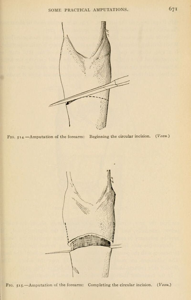 Fig. 514—Amputation of the forearm: Beginning the circular incision. {Veau.) Fig. sis.—Amputation of the forearm: Completing the circular incision. (Veau.)