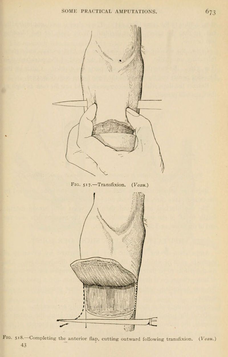 Fig. 517.—Transfixion. (Vcau.) I'ig. 518. Completing the anterior Hap, cutting outward following transfixion. (Vraw.) 43