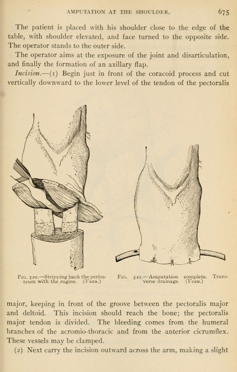 The patient is placed with his shoulder close to the edge of the table, with shoulder elevated, and face turned to the opposite Side. The operator stands to the outer side. The operator aims at the exposure of the joint and disarticulation, and finally the formation of an axillary flap. Incision.—(1) Begin just in front of the coracoid process and cut vertically downward to the lower level of the tendon of the pectoralis Fig. 520.—Stripping back the perios- teum with the rugine. (Veau.) Fig. 521.—Amputation complete. Trans- verse drainage. (Vcau.) major, keeping in front of the groove between the pectoralis major and deltoid. This incision should reach the bone; the pectoralis major tendon is divided. The bleeding comes from the humeral branches of the acromio-thoracic and from the anterior cicrumtlex. These vessels may be clamped. (2) Next carry the incision outward across the arm, making a slight