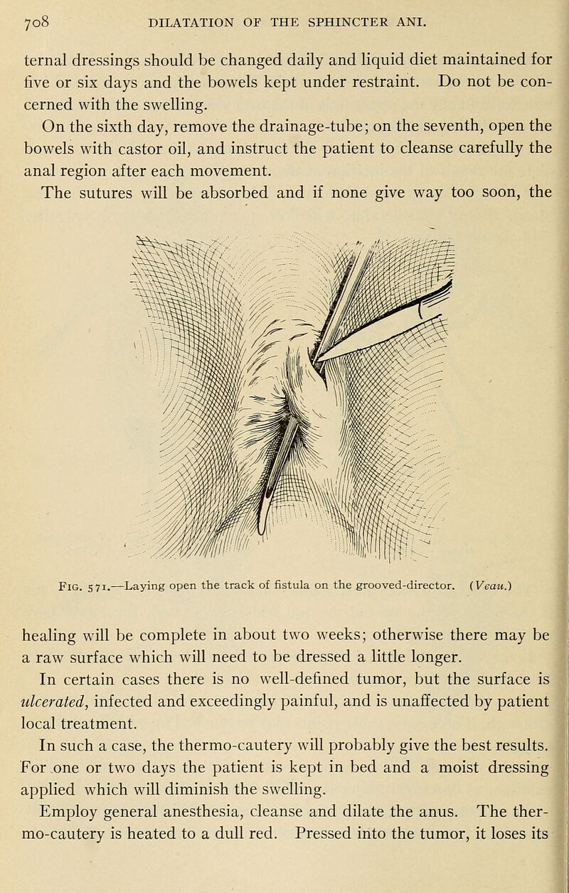 ternal dressings should be changed daily and liquid diet maintained for five or six days and the bowels kept under restraint. Do not be con- cerned with the swelling. On the sixth day, remove the drainage-tube; on the seventh, open the bowels with castor oil, and instruct the patient to cleanse carefully the anal region after each movement. The sutures will be absorbed and if none give way too soon, the Fig. 571-—Laying open the track of fistula on the grooved-director. (Veau.) healing will be complete in about two weeks; otherwise there may be a raw surface which will need to be dressed a little longer. In certain cases there is no well-defined tumor, but the surface is ulcerated, infected and exceedingly painful, and is unaffected by patient local treatment. In such a case, the thermo-cautery will probably give the best results. For .one or two days the patient is kept in bed and a moist dressing applied which will diminish the swelling. Employ general anesthesia, cleanse and dilate the anus. The ther- mo-cautery is heated to a dull red. Pressed into the tumor, it loses its