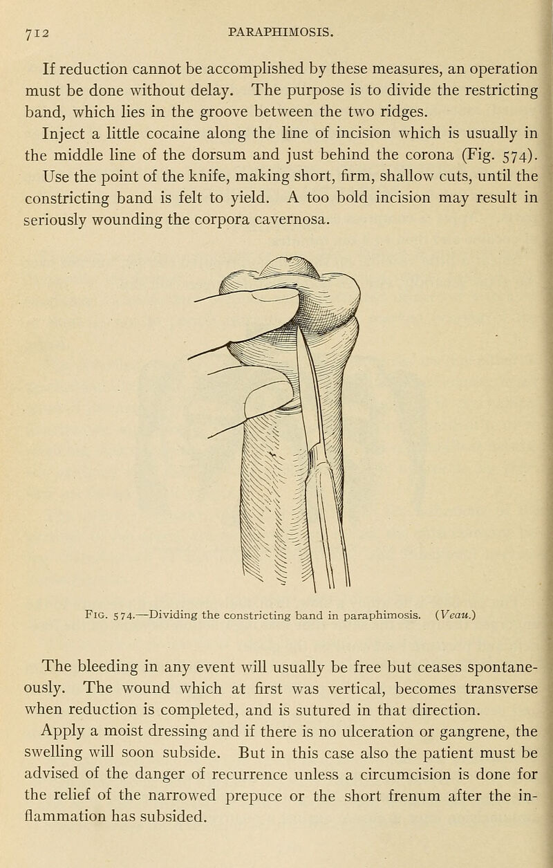 If reduction cannot be accomplished by these measures, an operation must be done without delay. The purpose is to divide the restricting band, which lies in the groove between the two ridges. Inject a little cocaine along the line of incision which is usually in the middle line of the dorsum and just behind the corona (Fig. 574). Use the point of the knife, making short, firm, shallow cuts, until the constricting band is felt to yield. A too bold incision may result in seriously wounding the corpora cavernosa. Fig. 574.—Dividing the constricting band in paraphimosis. (Veau.) The bleeding in any event will usually be free but ceases spontane- ously. The wound which at first was vertical, becomes transverse when reduction is completed, and is sutured in that direction. Apply a moist dressing and if there is no ulceration or gangrene, the swelling will soon subside. But in this case also the patient must be advised of the danger of recurrence unless a circumcision is done for the relief of the narrowed prepuce or the short frenum after the in- flammation has subsided.