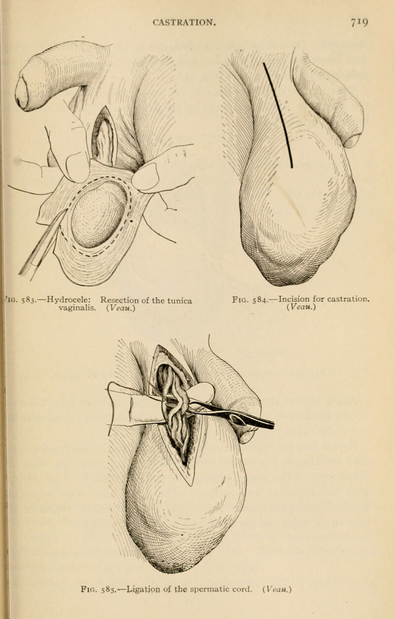 po. 583.—Hydrocele: Resection of the tunica Fig. 584.—Incision for castration, vaginalis. (Vcau.) (Veau.) Fin. 585.—Ligation of the spermatic cord. {Veau.)