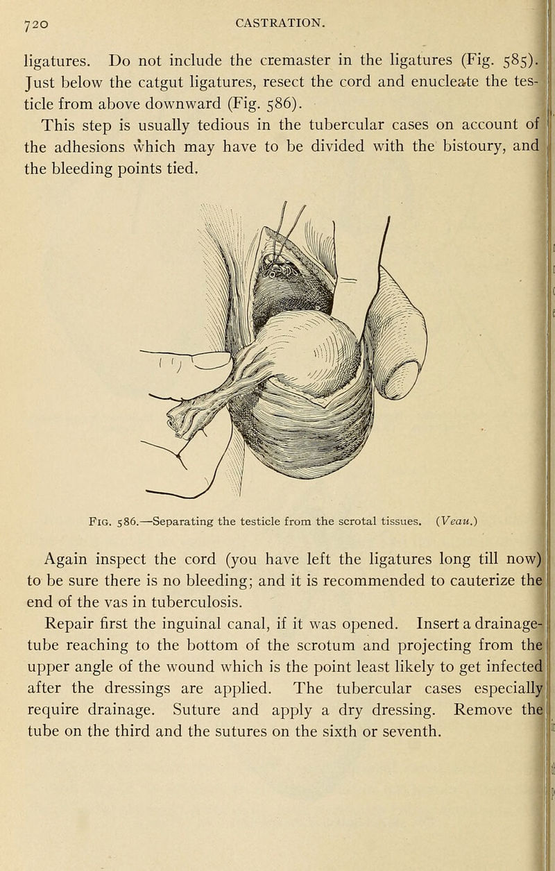 CASTRATION. ligatures. Do not include the cremaster in the ligatures (Fig. 585). Just below the catgut ligatures, resect the cord and enucleate the tes-] tide from above downward (Fig. 586). This step is usually tedious in the tubercular cases on account of! the adhesions which may have to be divided with the bistoury, and the bleeding points tied. Fig. 586.—Separating the testicle from the scrotal tissues. (Veau.) Again inspect the cord (you have left the ligatures long till now) to be sure there is no bleeding; and it is recommended to cauterize the end of the vas in tuberculosis. Repair first the inguinal canal, if it was opened. Insert a drainage- tube reaching to the bottom of the scrotum and projecting from the: upper angle of the wound which is the point least likely to get infected after the dressings are applied. The tubercular cases especially require drainage. Suture and apply a dry dressing. Remove tha tube on the third and the sutures on the sixth or seventh.