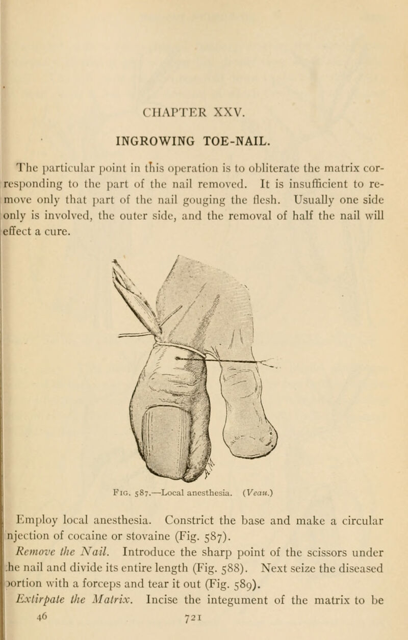 ( IIAI'IIR XXV. INGROWING TOE-NAIL. The particular point in tin's operation is to obliterate the matrix cor- fesponding to the pari of the nail removed. It is insufficient to re- move only that part of the nail gouging the flesh. Usually one side only is involved, the outer side, and the removal of half the nail will effect a cure. Fig. 587.—Local anesthesia. (Veau.) Employ local anesthesia. Constrict the base and make a circular njei lion of cocaine or stovaine (Fig. 587). Remove the Nail. Introduce the sharp point of the scissors under be nail and divide its entire length (Fig. 588). Next seize the diseased prtion with a forceps and tear it out (Fig. 589). Extirpate the Matrix. Incise the integument of the matrix to be