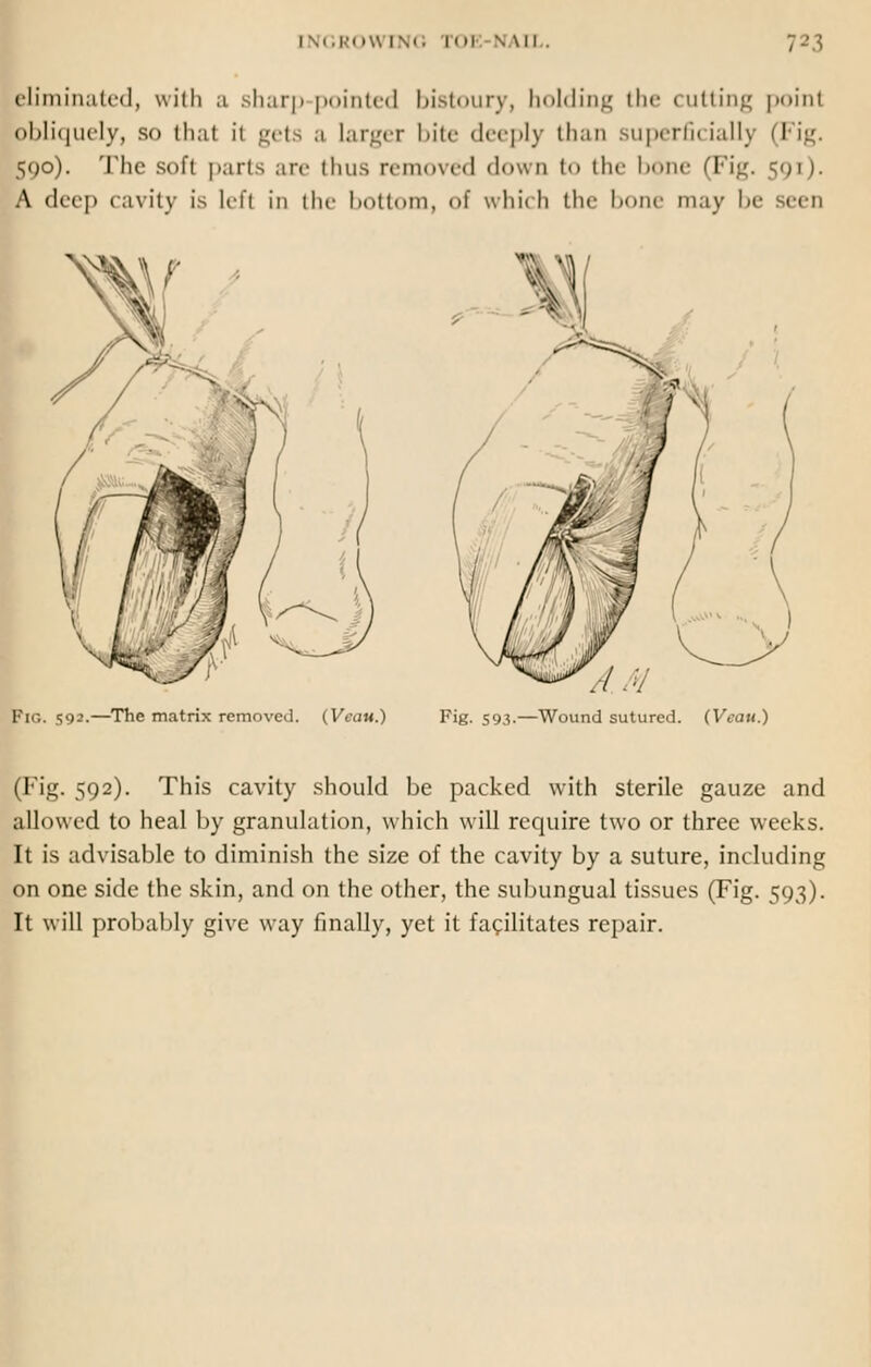 INGROWING I I NAIL. eliminated, with a sharp pointed bistoury, holding the cutting poinl obliquely, so thai it gets a larger bite deeply than superficially (1 590). The soft parts are thus removed down f th<- bone (Fig. 591). A deep cavity is Left in the bottom, <>f which the bone may be Fig. 592.—The matrix removed. (Veau.) A.M Fig. 593.—Wound sutured. (Vcau.) (Fig. 592). This cavity should be packed with sterile gauze and allowed to heal by granulation, which will require two or three wicks. It is advisable to diminish the size of the cavity by a suture, including on one side the skin, and on the other, the subungual tissues (Fig. 593). It will probably give way finally, yet it facilitates repair.