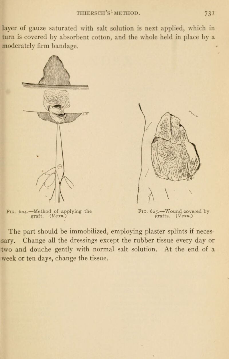 layer of gauze saturated with salt solution is next applied, which in turn is covered by absorbent cotton, and the whole held in place by a moderately firm bandage. /\ Fig. 604.—Method of applying the graft. (Veau.) Fig. 605.—Wound covered by grafts. {Veau.) The part should be immobilized, employing plaster splints if neces- sary. Change all the dressings except the rubber tissue every day or two and douche gently with normal salt solution. At the end of a week or ten days, change the tissue.