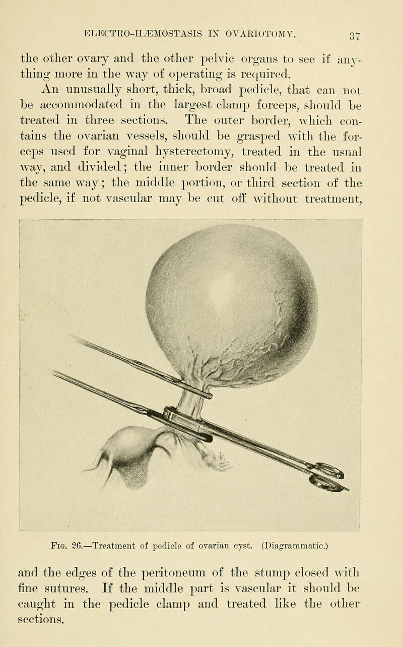 m tlie other ovary and tlie otlier pelvic organs to see if any- thing more in the way of operating is required. An unusually short, thick, broad pedicle, that can not be accommodated in the largest clamp forceps, should be treated in three sections. The outer border, which con- tains the ovarian vessels, should be grasped wdth the for- ceps used for vaginal hysterectomy, treated in the usual way, and divided; the inner border should be treated in the same way; the middle portion, or third section of the pedicle, if not vascular may be cut oif without treatment, Fig. 26.—Treatment of pedicle of ovarian cyst. (Diagrammatic.) and the edges of the peritoneum of the stump closed with fine sutures. If the middle part is vascular it should be caught in the pedicle clamp and treated like the other sections.