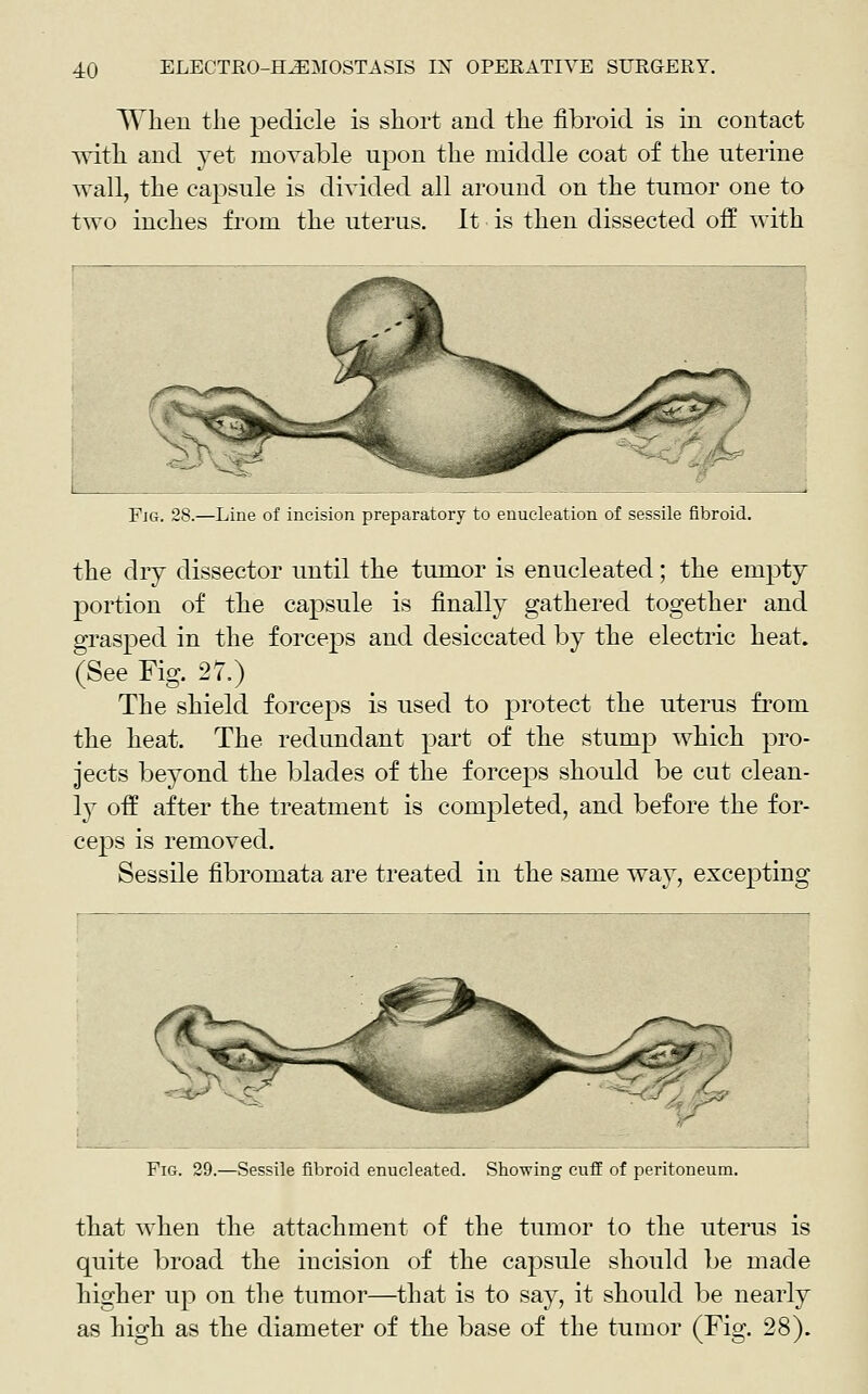 When the pedicle is short and the fibroid is in contact ■with and yet movable upon the middle coat of the uterine wall, the capsule is divided all around on the tumor one to two inches from the uterus. It is then dissected off with ^<j^j&^ Fig. 28.—Line of incision preparatory to enucleation of sessile fibroid. the dry dissector until the tumor is enucleated; the empty portion of the capsule is finally gathered together and grasped in the forceps and desiccated by the electric heat. (See Fig. 27.) The shield forceps is used to protect the uterus fi'om the heat. The redundant part of the stump which pro- jects beyond the blades of the forceps should be cut clean- ly off after the treatment is completed, and before the for- ceps is removed. Sessile fibromata are treated in the same way, excepting Fig. 29.—Sessile fibroid enucleated. Showing cuff of peritoneum. that when the attachment of the tumor to the uterus is quite broad the incision of the capsule should be made higher up on the tumor—that is to say, it should be nearly as high as the diameter of the base of the tumor (Fig. 28).