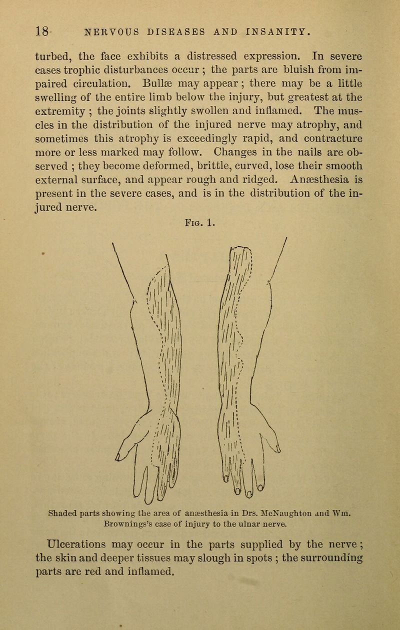 turbed, the face exhibits a distressed expression. In severe cases trophic disturbances occur ; the parts are bluish from im- paired circulation. Bullae may appear; there may be a little swelling of the entire limb below the injury, but greatest at the extremity ; the joints slightly swollen and inflamed. The mus- cles in the distribution of the injured nerve may atrophy, and sometimes this atrophy is exceedingly rapid, and contracture more or less marked may follow. Changes in the nails are ob- served ; they become deformed, brittle, curved, lose their smooth external surface, and appear rough and ridged. Anaesthesia is present in the severe cases, and is in the distribution of the in- jured nerve. Fig. 1. Shaded parts showing the area of anaesthesia in Drs. McNaughton and Wm. Brownings's case of injury to the ulnar nerve. Ulcerations may occur in the parts supplied by the nerve; the skin and deeper tissues may slough in spots ; the surrounding parts are red and inflamed.