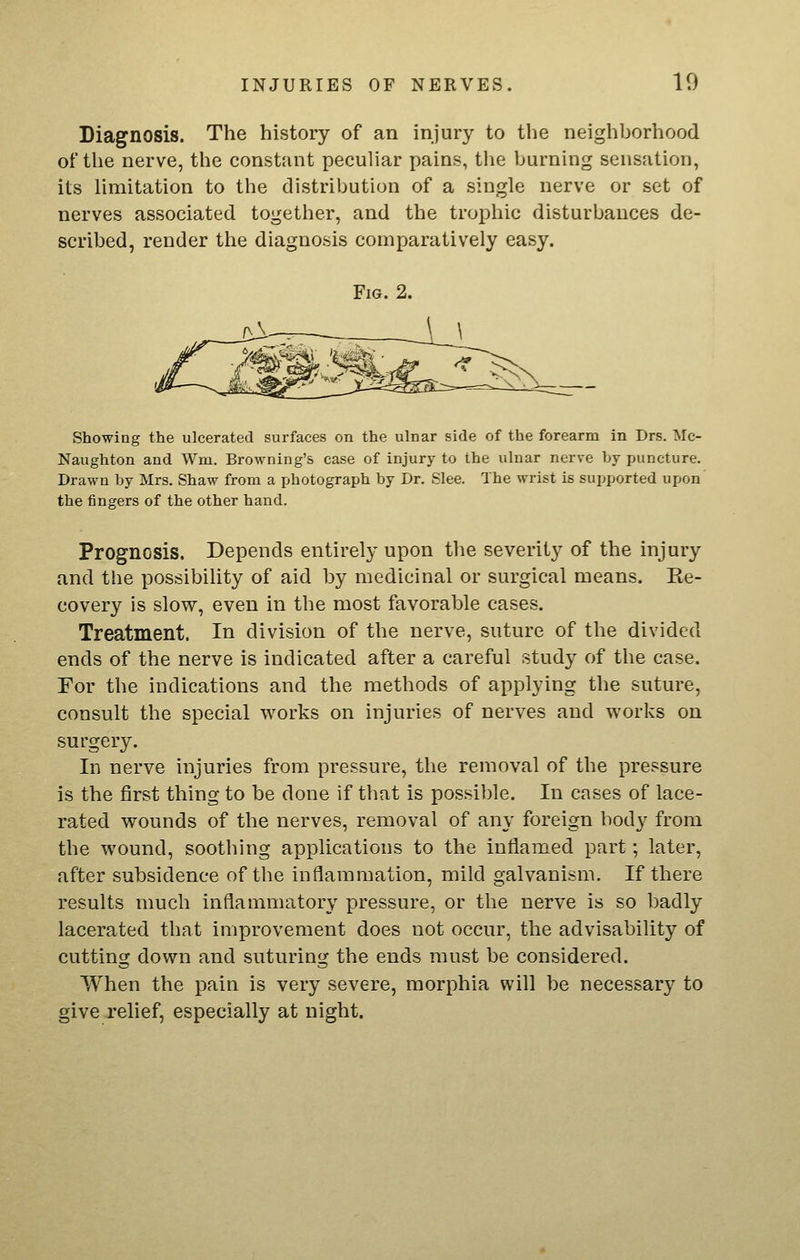 Diagnosis. The history of an injury to the neighborhood of the nerve, the constant peculiar pains, the burnhig sensation, its limitation to the distribution of a single nerve or set of nerves associated together, and the trophic disturbances de- scribed, render the diagnosis comparatively easy. Showing the ulcerated surfaces on the ulnar side of the forearm in Drs. Mc- Naughton and Wm. Browning's case of injury to the ulnar nerve by puncture. Drawn by Mrs. Shaw from a photograph by Dr. Slee. The wrist is supported upon the fingers of the other hand. Prognosis. Depends entirely upon the severity of the injury and the possibility of aid by medicinal or surgical means. Re- covery is slow, even in the most favorable cases. Treatment. In division of the nerve, suture of the divided ends of the nerve is indicated after a careful study of the case. For the indications and the methods of applying the suture, consult the special works on injuries of nerves and works on surgery. In nerve injuries from pressure, the removal of the pressure is the first thing to be done if that is possible. In cases of lace- rated wounds of the nerves, removal of any foreign body from the wound, soothing applications to the inflamed part; later, after subsidence of the inflammation, mild galvanism. If there results much inflammatory pressure, or the nerve is so badly lacerated that improvement does not occur, the advisability of cutting down and suturing the ends must be considered. When the pain is very severe, morphia will be necessary to give relief, especially at night.