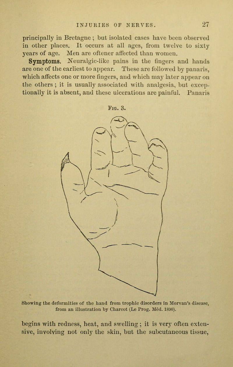 principally in Bretagne ; but isolated cases have been observed in other places. It occurs at all ages, from twelve to sixty years of age. Men are oftener affected than women. Symptoms. Neuralgic-like pains in the fingers and hands are one of the earliest to appear. These are followed by panaris, which affects one or more fingers, and which may later appear on the others ; it is usually associated with analgesia, but excep- tionally it is absent, and these ulcerations are painful. Panaris Showing the deformities of the hand from trophic disorders in Morvan's disease, from an illustration by Charcot (Le Prog. Med. 1890). begins with redness, heat, and swelling ; it is very often exten- sive, involving not only the skin, but the subcutaneous tissue,
