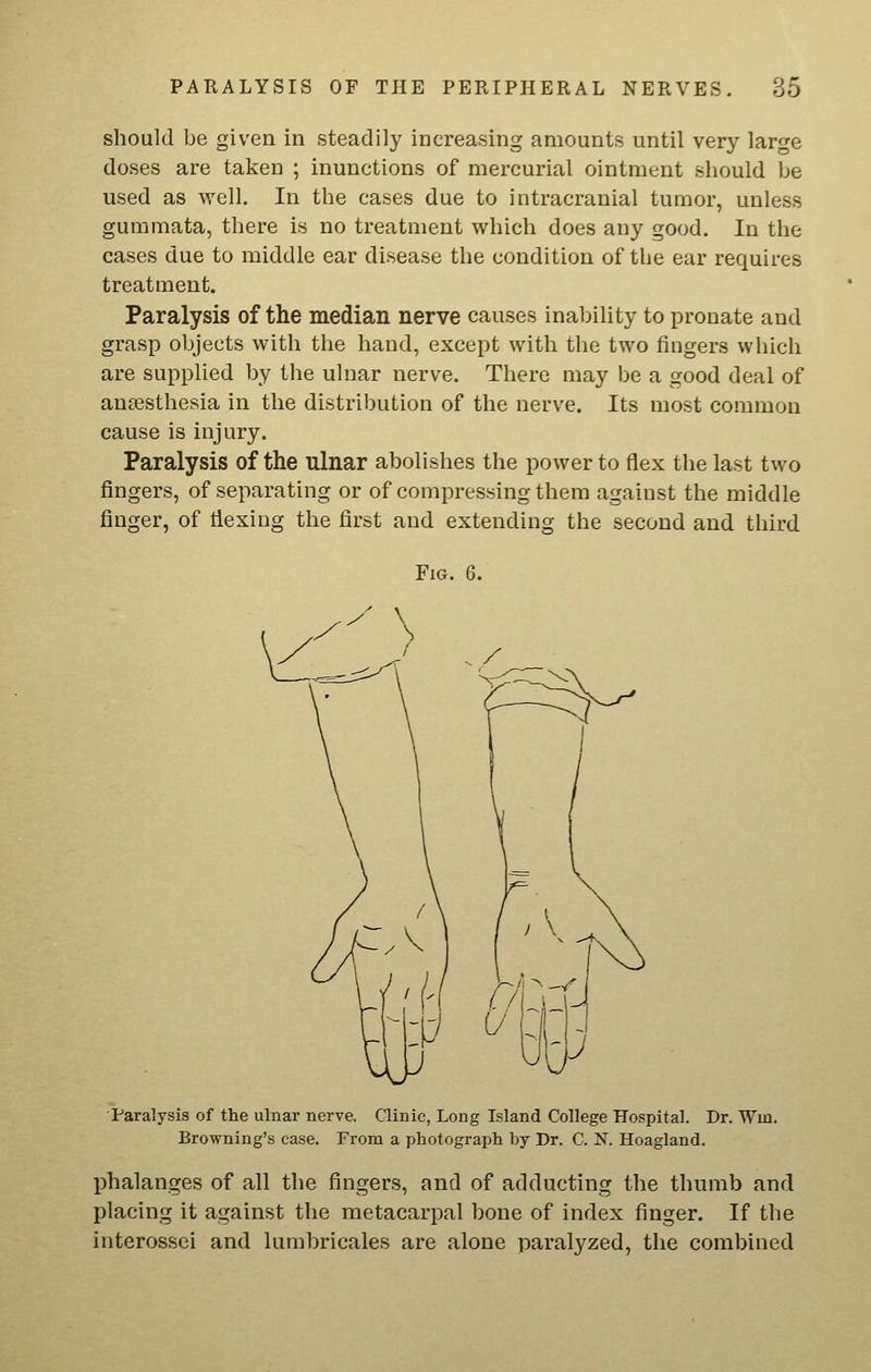 should be given in steadily increasing amounts until very large doses are taken ; inunctions of mercurial ointment should be used as well. In the cases due to intracranial tumor, unless gummata, there is no treatment which does any good. In the cases due to middle ear disease the condition of the ear requires treatment. Paralysis of the median nerve causes inabihty to pronate and grasp objects with the hand, except with the two fingers which are supplied by the ulnar nerve. There may be a good deal of anaesthesia in the distribution of the nerve. Its most common cause is injury. Paralysis of the ulnar abolishes the power to flex the last two fingers, of separating or of compressing them against the middle finger, of flexing the first and extending the second and third Fig. 6. Paralysis of the ulnar nerve. Clinic, Long Island College Hospital. Dr. Win. Browning's case. From a photograph by Dr. C. N. Hoagland. phalanges of all the fingers, and of adducting the thumb and placing it against the metacarpal bone of index finger. If the interossei and lumbricales are alone paralyzed, the combined