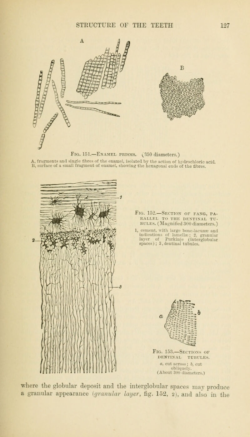 STRUCTURE OF THE TEETH A 127 Fig. 151.—Enamel prisms. ^350 diameters.) A, fragments and single fibres of the enamel, isolated by the action of hydrochloric acid B, surface of a small fragment of enamel, showing the hexagonal ends of the fibres. Fig. 152.—Section of fang, pa- rallel To THE DENTINAL TU- BULE-. (Magnified 300 diameters.) 1, cement, with large bone-lacuna- and indications ; 2, granular layer ot Purkinje (interglobular spaces); 3,dentinal tubules. Fig. 153.—Si < rioxs or DENTINAL TUBULES. a, cut across : b. cut obliquely. (About 300 diameters.) where the globular deposit and the interglobular spaces may produce a granular appearance [granular layer, fig. l'rl, 2), and also in the