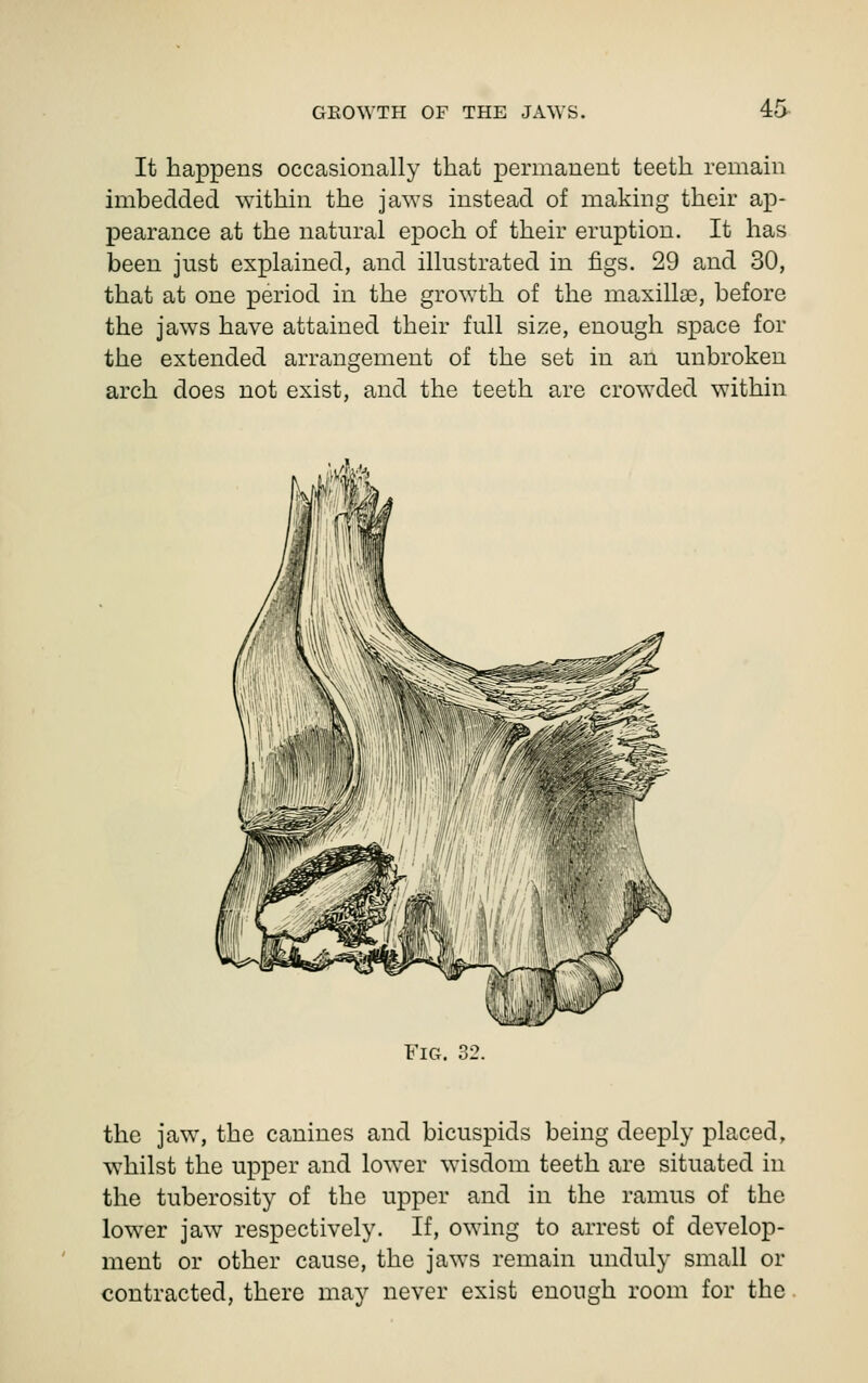 It happens occasionally that permanent teeth remain imbedded within the jaws instead of making their aj)- pearance at the natural epoch of their eruption. It has been just explained, and illustrated in figs. 29 and 30, that at one period in the growth of the maxillae, before the jaws have attained their full size, enough space for the extended arrangement of the set in an unbroken arch does not exist, and the teeth are crowded within Fig. 32. the jaw, the canines and bicuspids being deeply placed, whilst the upper and lower wisdom teeth are situated in the tuberosity of the upper and in the ramus of the lower jaw respectively. If, owing to arrest of develop- ment or other cause, the jaws remain unduly small or contracted, there may never exist enough room for the