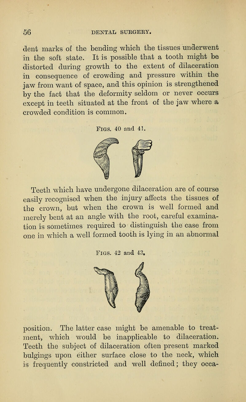 dent marks of the bending which the tissues underwent in the soft state. It is possible that a tooth might be distorted during growth to the extent of dilaceration in consequence of crowding and pressure within the jaw from want of space, and this opinion is strengthened by the fact that the deformity seldom or never occurs except in teeth situated at the front of the jaw where a crowded condition is common. Figs. 40 and 41. Teeth which have undergone dilaceration are of course easily recognised when the injury affects the tissues of the crown, but when the crown is well formed and merely bent at an angle with the root, careful examina- tion is sometimes required to distinguish the case from one in which a well formed tooth is lying in an abnormal Figs. 42 and 43, position. The latter case might be amenable to treat- ment, which would be inapplicable to dilaceration. Teeth the subject of dilaceration often present marked bulgings upon either surface close to the neck, which is frequently constricted and well defined; they occa-