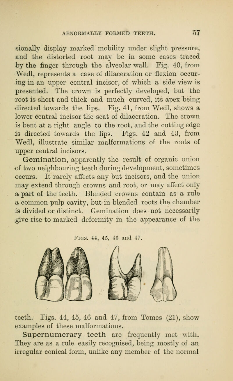 sioually display marked mobility under slight pressm-e, and the distorted root may be in some cases traced by the finger through the alveolar wall. Fig. 40, from Wedl, represents a case of dilaceration or flexion occur- ing in an upper central incisor, of which a side view is presented. The crown is perfectly developed, but the root is short and thick and much curved, its apex being directed towards the lips. Fig. 41, from Wedl, shows a lower central incisor the seat of dilaceration. The crown is bent at a right angle to the root, and the cutting edge is directed towards the lips. Figs. 42 and 43, from Wedl, illustrate similar malformations of the roots of upper central incisors. Gemination, apparently the result of organic union of two neighbouring teeth during development, sometimes occurs. It rarely affects any but incisors, and the union may extend through crowns and root, or may affect only a part of the teeth. Blended crowns contain as a rule a common pulp cavity, but in blended roots the chamber is divided or distinct. Gemination does not necessarily give rise to marked deformity in the appearance of the Figs. 44, 45. 4(5 and 47. teeth. Figs. 44, 45, 46 and 47, from Tomes (21), show examples of these malformations. Supernumerary teeth are frequently met with. They are as a rule easily recognised, being mostly of an irregular conical form, unlike any member of the normal