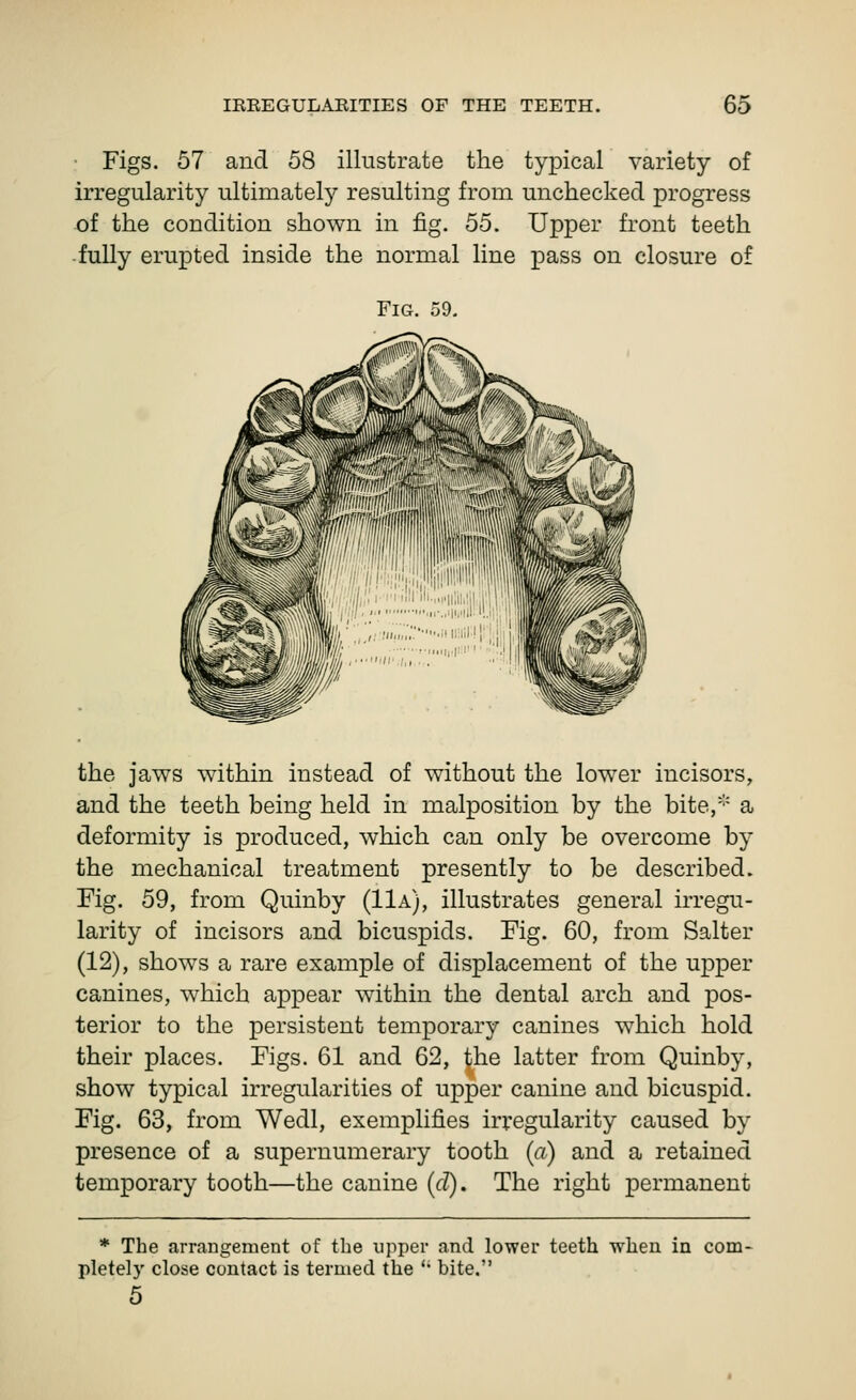 • Figs. 57 and 58 illustrate the typical variety of irregularity ultimately resulting from unchecked progress of the condition shown in fig. 55. Upper front teeth fully erupted inside the normal line pass on closure of Fig. 59, the jaws within instead of without the lower incisors, and the teeth being held in malposition by the bite, a deformity is produced, which can only be overcome by the mechanical treatment presently to be described. Fig. 59, from Quinby (11a), illustrates general irregu- larity of incisors and bicuspids. Fig. 60, from Salter (12), shows a rare example of displacement of the upper canines, which appear within the dental arch and pos- terior to the persistent temporary canines which hold their places. Figs. 61 and 62, ^he latter from Quinby, show typical irregularities of upper canine and bicuspid. Fig. 63, from Wedl, exemplifies irregularity caused by presence of a supernumerary tooth (a) and a retained temporary tooth—the canine (d). The right permanent * The arrangement of the upper and lower teeth when in com- pletely close contact is termed the '* bite. 5