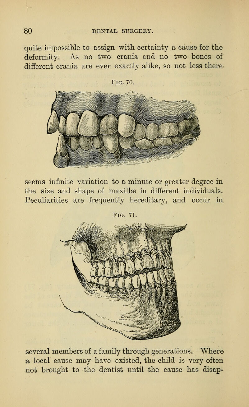 quite impossible to assign with certainty a cause for the deformity. As no two crania and no two bones of different crania are ever exactly alike, so not less there- Fig. 70. seems infinite variation to a minute or greater degree in the size and shape of maxillae in different individuals. Peculiarities are frequently hereditary, and occur in Fig. 71. several members of a family through generations. Where a local cause may have existed, the child is very often not brought to the dentist until the cause has disap-