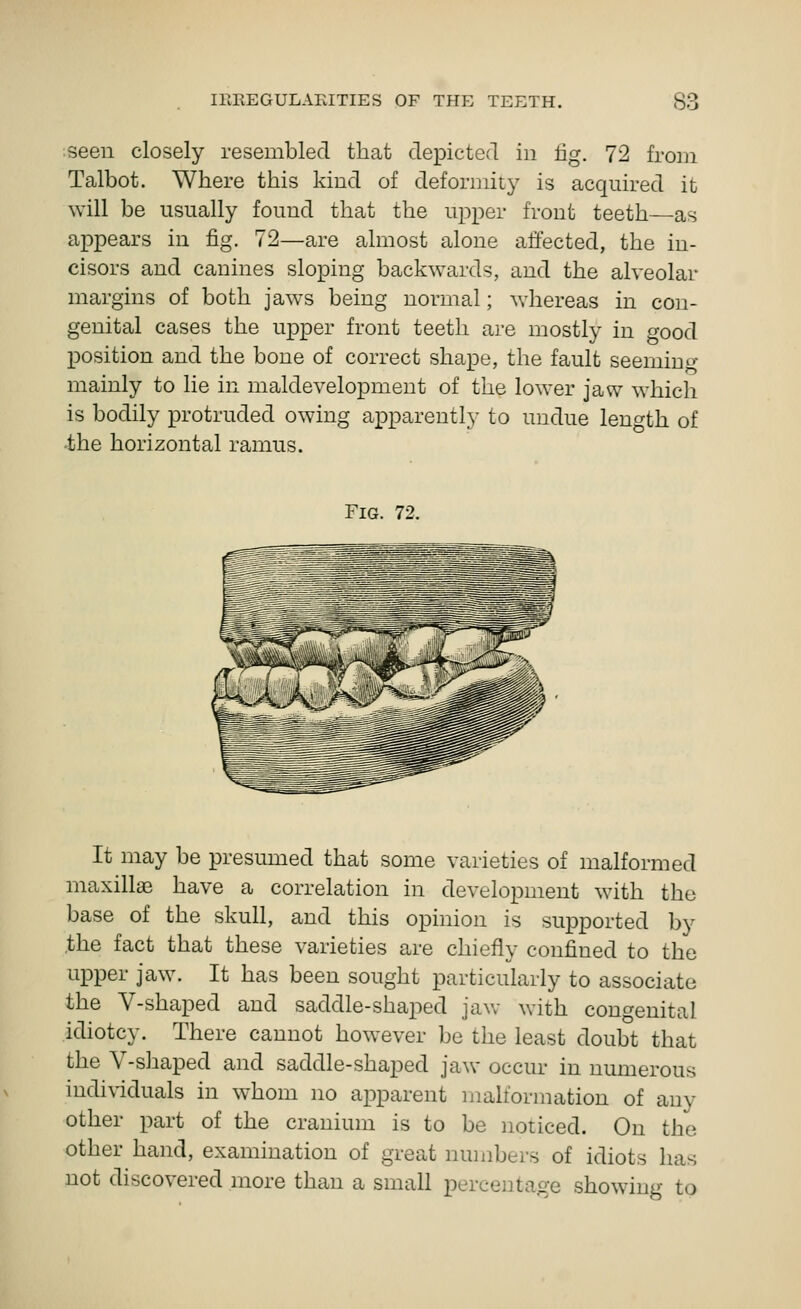 seen closely resembled that depicted in fig. 72 from Talbot. Where this kind of deformity is acquired it will be usually found that the upper front teeth—as appears in fig. 72—are almost alone affected, the in- cisors and canines sloping backwards, and the alveolar margins of both jaws being normal; whereas in con- genital cases the upper front teeth are mostly in o-ood position and the bone of correct shape, the fault seemin^- mainly to lie in maldevelopment of the lower jaw which is bodily protruded owing apparently to undue length of the horizontal ramus. Fig. 72. It may be presumed that some varieties of malformed maxillae have a correlation in development with the base of the skull, and this opinion is supported by the fact that these varieties are chiefly confined to the upper jaw. It has been sought particularly to associate the V-shaped and saddle-shaped jaw with congenital idiotcy. There cannot however be the least doubt that the V-shaped and saddle-shaped jaw occur in numerous individuals in whom no apparent malformation of any other part of the cranium is to be noticed. On the other hand, examination of great niunbers of idiots has not discovered more than a small percentage showing to