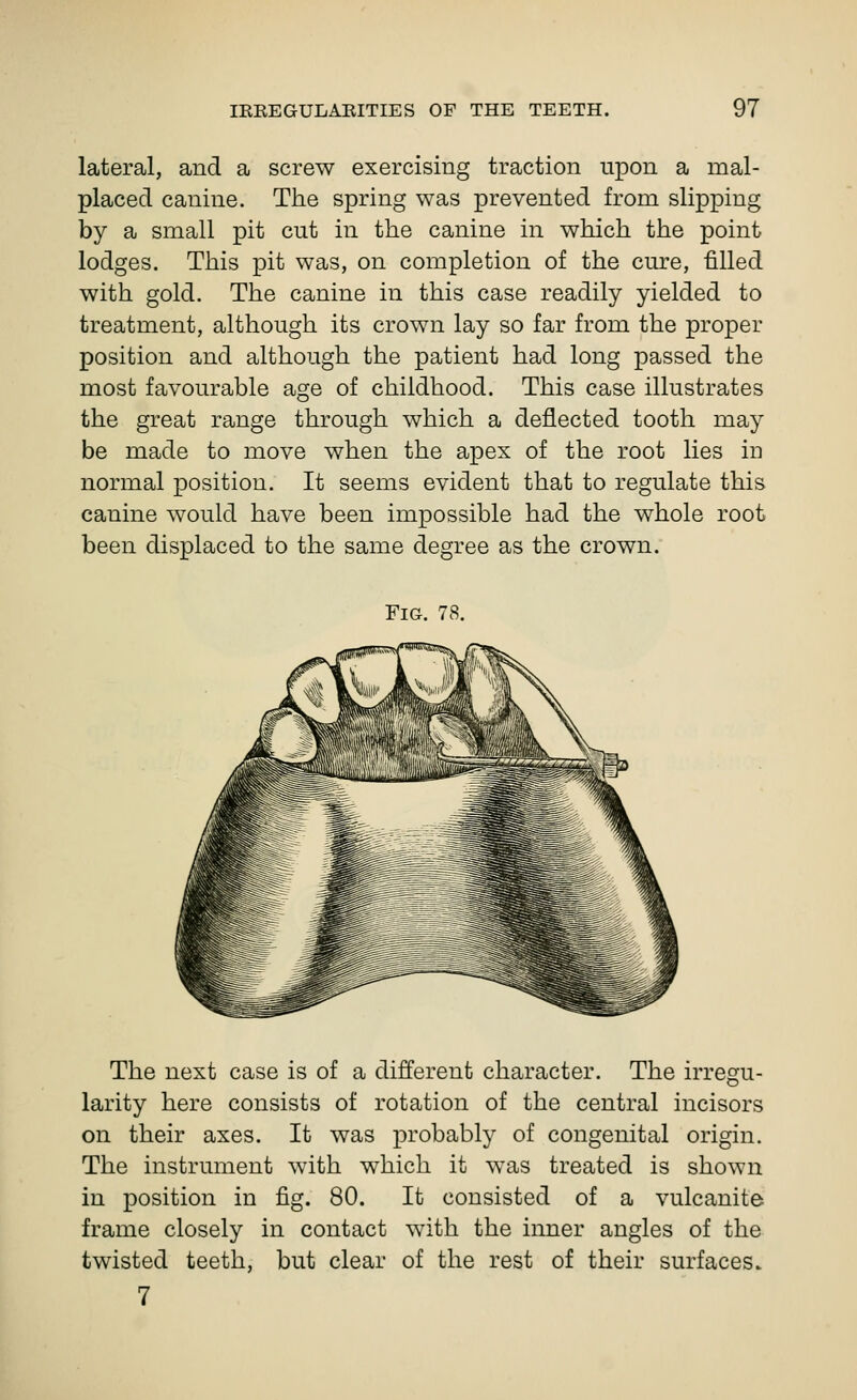 lateral, and a screw exercising traction upon a mal- placed canine. The spring was prevented from slipping by a small pit cut in the canine in which the point lodges. This pit was, on completion of the cure, filled with gold. The canine in this case readily yielded to treatment, although its crown lay so far from the proper position and although the patient had long passed the most favourable age of childhood. This case illustrates the great range through which a deflected tooth may be made to move when the apex of the root lies in normal position. It seems evident that to regulate this canine would have been impossible had the whole root been displaced to the same degree as the crown. Fig. 78. The next case is of a different character. The irregu- larity here consists of rotation of the central incisors on their axes. It was probably of congenital origin. The instrument with which it was treated is shown in position in fig. 80. It consisted of a vulcanite frame closely in contact with the inner angles of the twisted teeth, but clear of the rest of their surfaces.