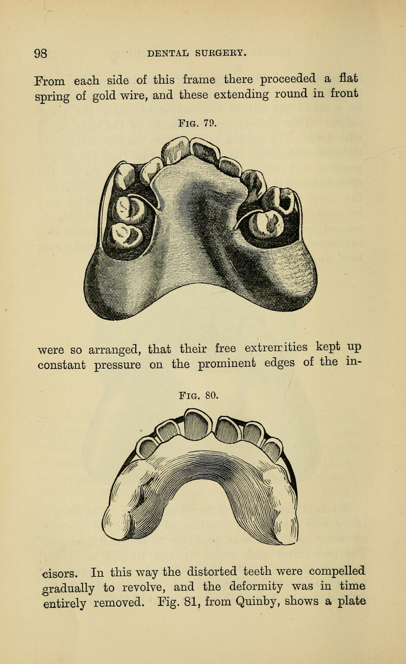 From each side of this frame there proceeded a flat spring of gold wire, and these extending round in front Fig. 79. were so arranged, that their free extremities kept up constant pressure on the prominent edges of the in- FiG. 80. •cisors. In this way the distorted teeth were compelled gradually to revolve, and the deformity was in time entirely removed. Eig. 81, from Quinby, shows a plate