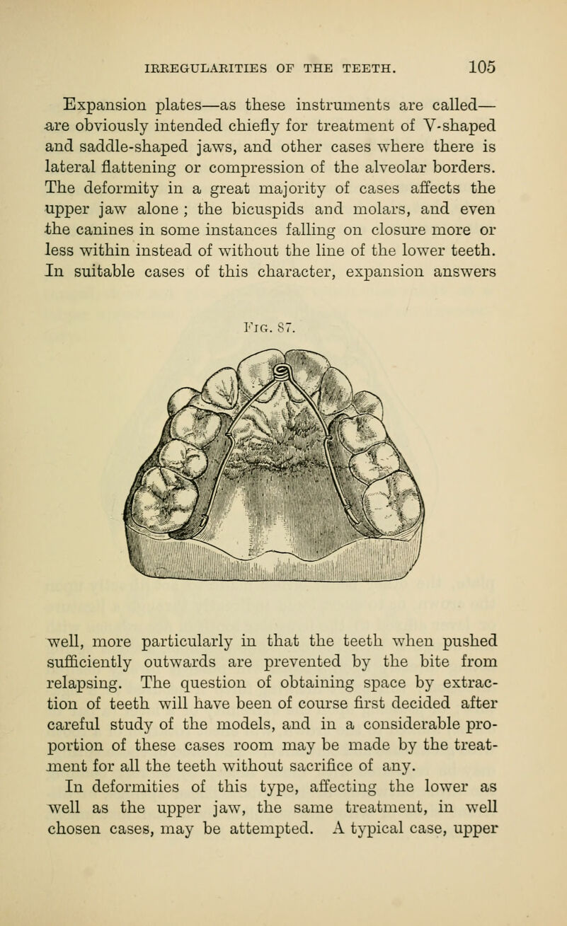 Expansion plates—as these instruments are called— •are obviously intended chiefly for treatment of V-shaped and saddle-shaped jaws, and other cases where there is lateral flattening or compression of the alveolar borders. The deformity in a great majority of cases affects the upper jaw alone ; the bicuspids and molars, and even the canines in some instances falling on closure more or less within instead of without the line of the lower teeth. In suitable cases of this character, expansion answers Fig. 87. well, more particularly in that the teeth when pushed sufficiently outwards are prevented by the bite from relapsing. The question of obtaining space by extrac- tion of teeth will have been of course first decided after careful study of the models, and in a considerable pro- portion of these cases room may be made by the treat- ment for all the teeth w^ithout sacrifice of any. In deformities of this type, affecting the lower as well as the upper jaw% the same treatment, in well chosen cases, may be attempted. A typical case, upper