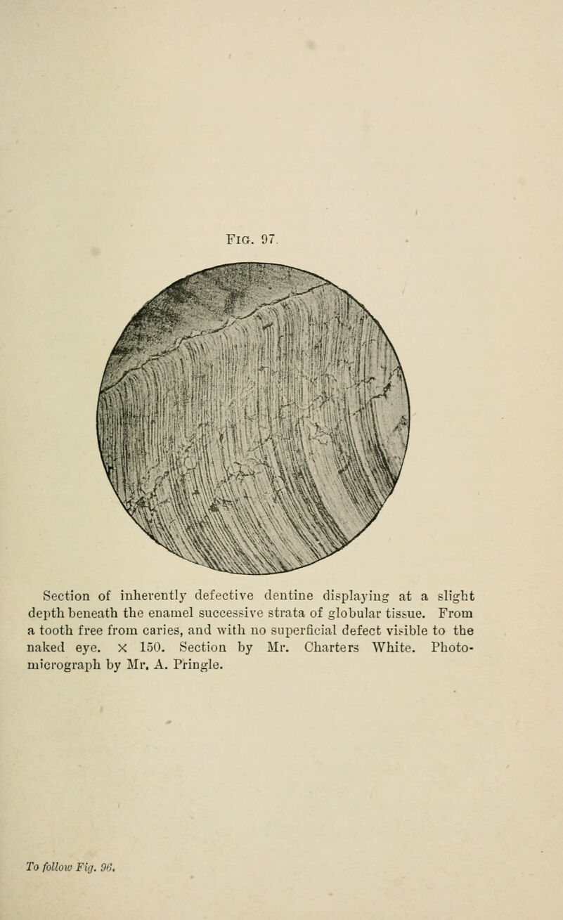 Section of inhevently defective dentine displaying at a slight depth beneath the enamel successive strata of globular tissue. From a tooth free from caries, and with no superficial defect visible to the naked eye. X 150. Section by Mr. Charters White. Photo- micrograph by Mr, A. Pringle.