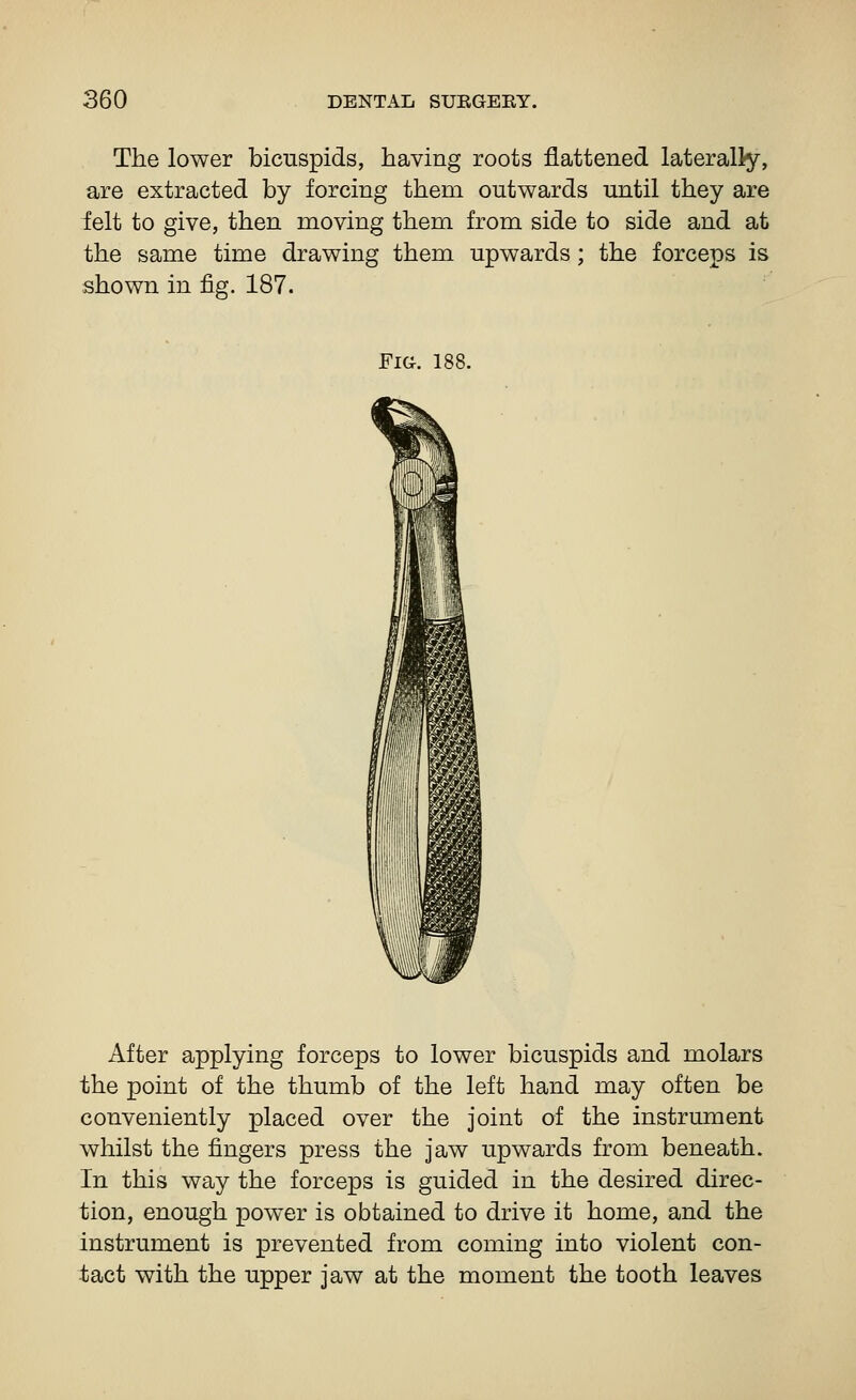 The lower bicuspids, having roots flattened laterally, are extracted by forcing them outwards until they are ielt to give, then moving them from side to side and at the same time drawing them upwards; the forceps is shown in fig. 187. Fic^. 188. After applying forceps to lower bicuspids and molars the point of the thumb of the left hand may often be conveniently placed over the joint of the instrument whilst the fingers press the jaw upwards from beneath. In this way the forceps is guided in the desired direc- tion, enough power is obtained to drive it home, and the instrument is prevented from coming into violent con- tact with the upper jaw at the moment the tooth leaves