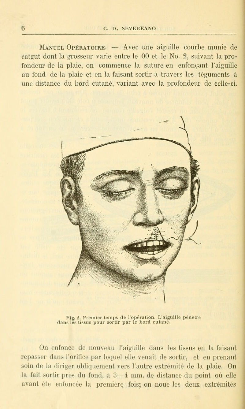 Manuel Opératoire. — Avec une aiguille courbe munie de catgut dont la grosseur varie entre le 00 et le No. 2, suivant la pro- fondeur de la plaie, on commence la suture en enfonçant l'aiguille au fond de la plaie et en la faisant sortir à travers les téguments à une distance du bord cutané, variant avec la profondeur de celle-ci. Fig. 5. Premier temps de l'opéralion. L'aiguille pénétre is les tissus pour sortir par le bord cutané. On enfonce de nouveau l'aiguille dans les tissus en la faisant repasser dans l'orifice par lequel elle venait de sortir, et en prenant soin de la diriger obliquement vers l'autre extrémité de la plaie. On la fait sortir près du fond, à 3—4 nua. de distance du point où elle avant été enfoncée la premièrq fois; on noue les deux extrémités