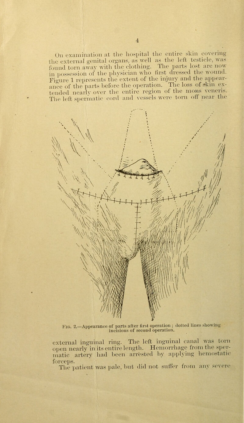 On examination at the hospital the entire skin covering the external genital organs, as well as the left testicle, was found torn away with the clothing. The parts lost are now in possession of the physician who iirst dressed the woiuid. Fio-ure 1 represents the extent of the injury and the appear- ance of the parts before the operation. The loss of skni ex- tended nearly over the entire region of the mons veneris. The left spermatic cord and vessels were torn oft near th(^ Fig. 2.—Appearance of parts after first operation ; clotted liues showing • incisions of second operation. external inguinal ring. The left inguinal canal Avas torn open nearly in its entire length. Hemorrhage from the sper- matic artery had been arrfested by applying hemostatic forceps. The patient was pale, but did not sufl'er from any severe