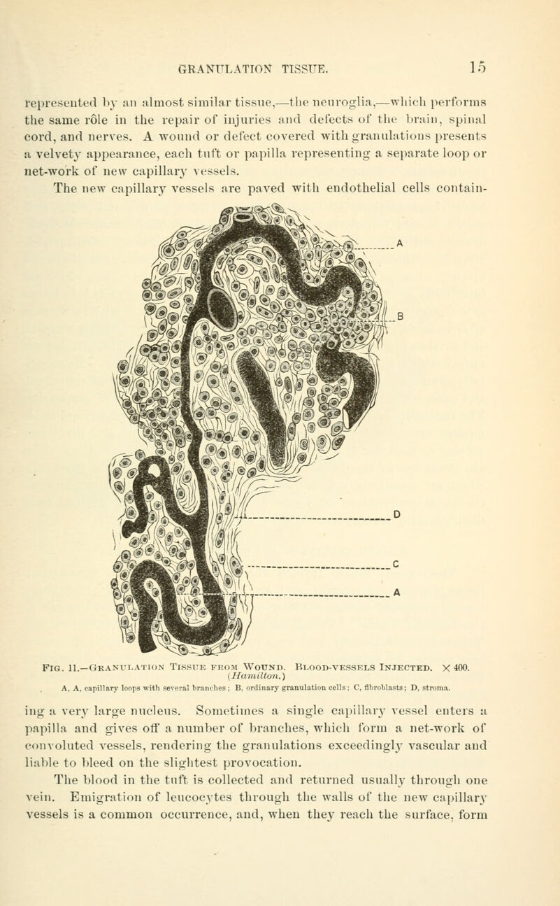 represented In- an almost similar tissne,—the neuroglia,—which performs the same role in the repair of injuries and defects of the brain, spinal cord, and nerves. A ■wound or defect covered with granulations presents a velvet}' appearance, each tuft or papilla representing a separate loop or net-work of new capillar}' vessels. The new capillary vessels are paved with endothelial cells contain- FiG. 11.—Gra>'Ulation Tissue fiuim Wound. Blood-vessels Injected. X 400. (IIamiUo7i.) A, A, capillary loops with several branches ; B. ordinary granulation cells; C, fibroblasts; D, stroma. ing a very large nucleus. Sometimes a single capillary vessel enters a papilla and gives off a number of branches, which form a net-work of convoluted vessels, rendering the granulations exceedingl}' vascular and liable to bleed on the slightest provocation. The blood in the tuft is collected and returned usually through one vein. Emigi'ation of leucocytes through the walls of the new capillary vessels is a common occurrence, and, when they reach the surface, form
