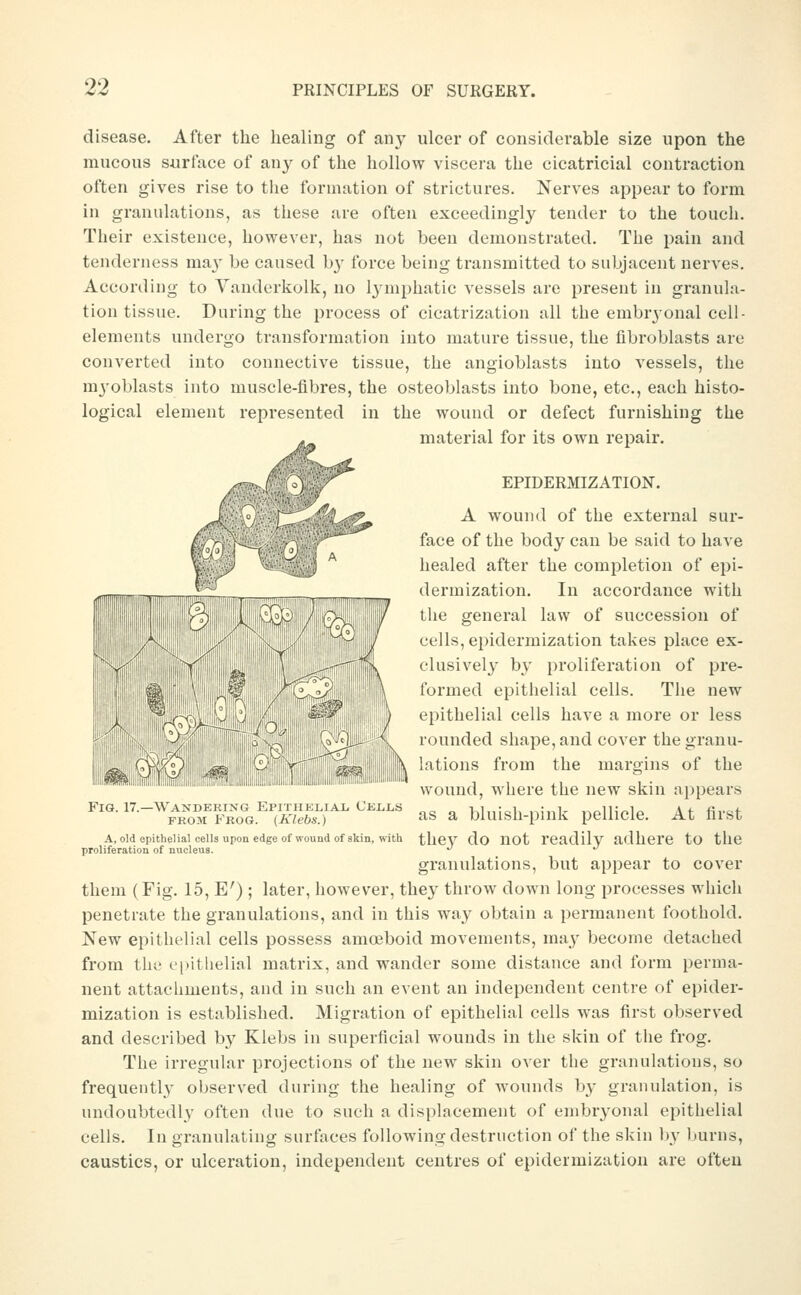 disease. After the healing of any ulcer of considerable size upon the mucous surface of any of the hollow viscera the cicatricial contraction often gives rise to the formation of strictures. Nerves appear to form in granulations, as these are often exceedingly tender to the touch. Their existence, however, has not been demonstrated. The pain and tenderness ma}' be caused b}' force being transmitted to subjacent nerves. According to Vanderkolk, no I3 mphatic vessels are present in granula- tion tissue. During the process of cicatrization all the embrjonal cell- elements undergo transformation into mature tissue, the fibroblasts are converted into connective tissue, the angioblasts into vessels, the mj'oblasts into muscle-fibres, the osteoblasts into bone, etc., each histo- logical element represented in the wound or defect furnishing the material for its own repair. EPIDERMIZATION. A wound of the external sur- face of the body can be said to have healed after the completion of epi- dermization. In accordance with the general law of succession of cells, epidermization takes place ex- clusively by proliferation of pre- formed epithelial cells. The new epithelial cells have a more or less rounded shape, and cover the granu- lations from the margins of the wound, where the new skin appears ^'''•''■-^'''^^^ff^^a''7KilbI:l'''''''''''' as a bluish-pink pellicle. At first A, old epithelial cells upon edge of wound of skin, with thcV do UOt readily adhere tO tllC proliferation of nucleus. '' ^ granulations, but appear to cover them (Fig. 15, E') ; later, however, the}' throw down long processes which penetrate the granulations, and in this way obtain a permanent foothold. New epithelial cells possess amoeboid movements, may become detached from the epithelial matrix, and wander some distance and form perma- nent attachments, and in such an event an independent centre of epider- mization is established. Migration of epithelial cells was first observed and described by Klebs in superficial wounds in the skin of tlie frog. The irregular projections of the new skin over the granulations, so frequently observed during the healing of wounds by granulation, is undoubtedly often due to such a displacement of embryonal epithelial cells. In granulating surfaces following destruction of the skin by burns, caustics, or ulceration, independent centres of epidermization are often